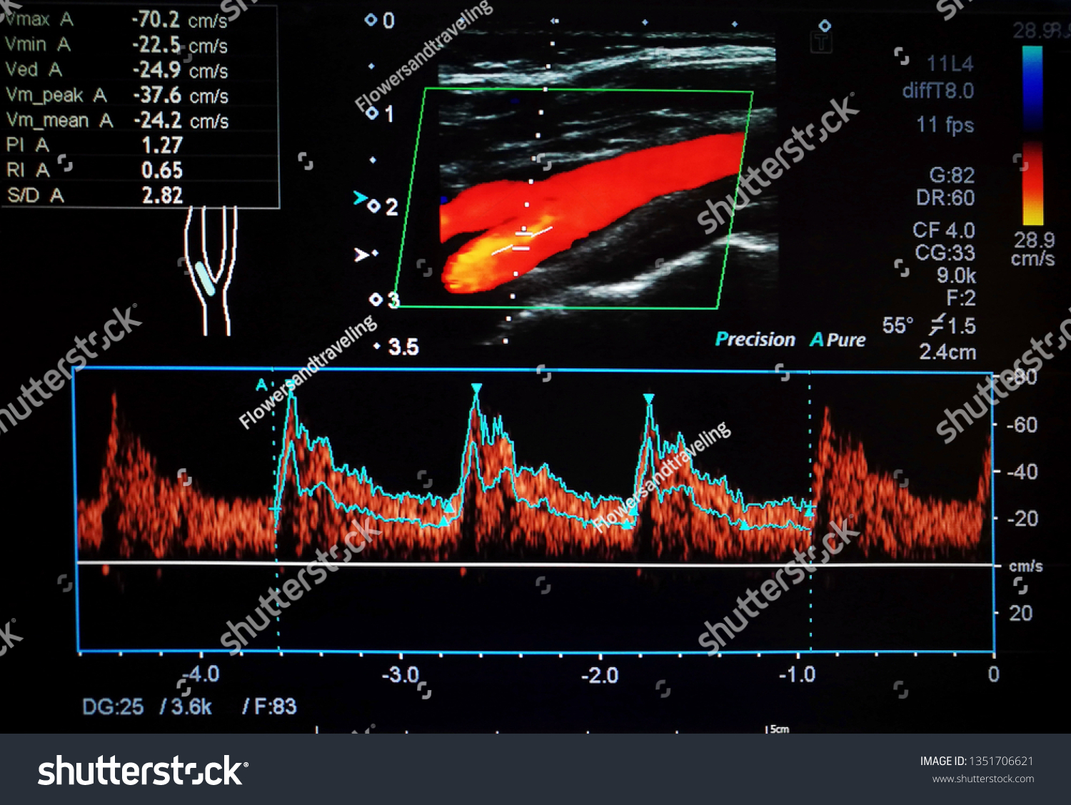 3,236 Colour doppler Images, Stock Photos & Vectors | Shutterstock