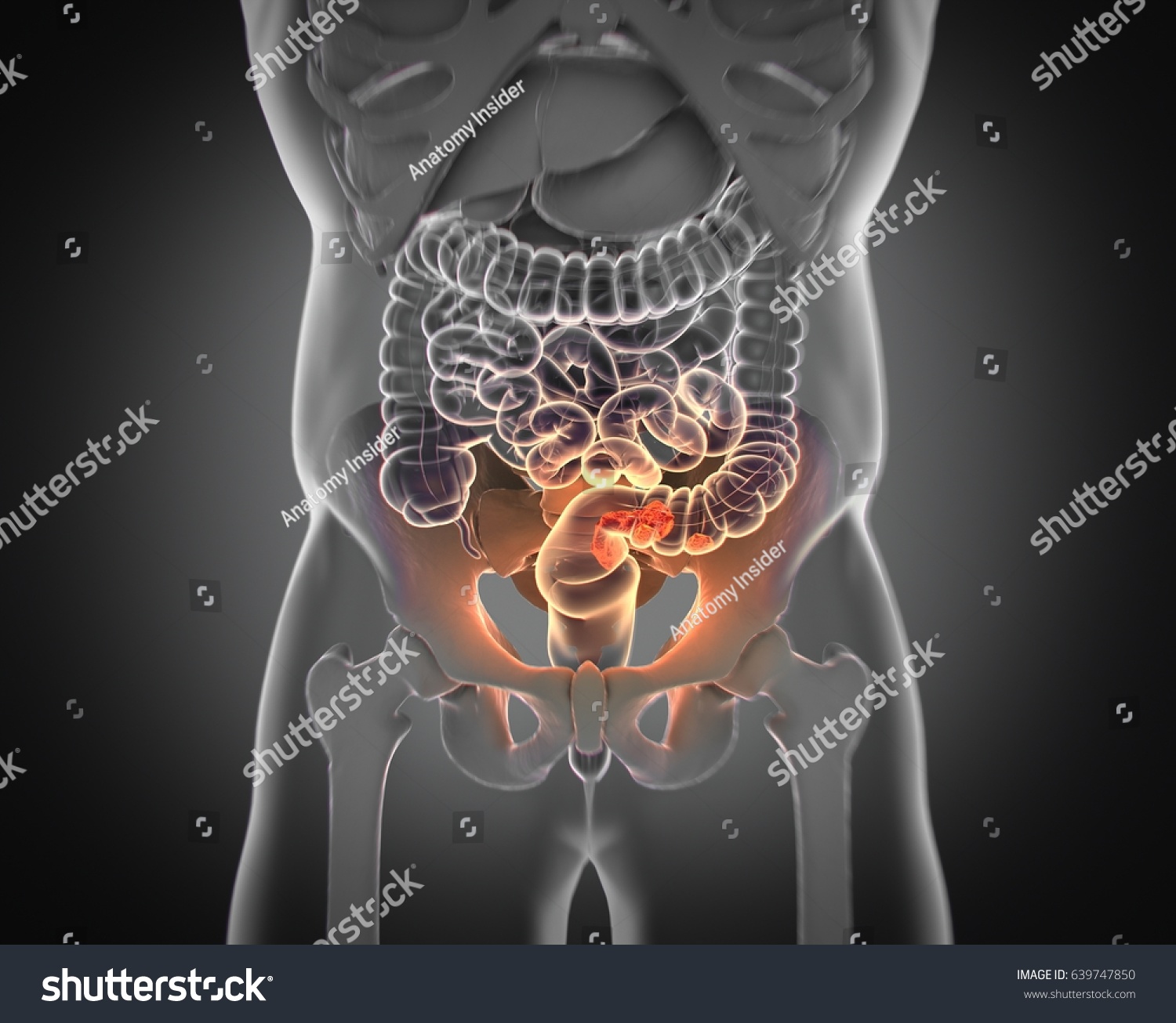 Colorectal Cancermedical Anatomical Illustration3d Illustration Stock ...