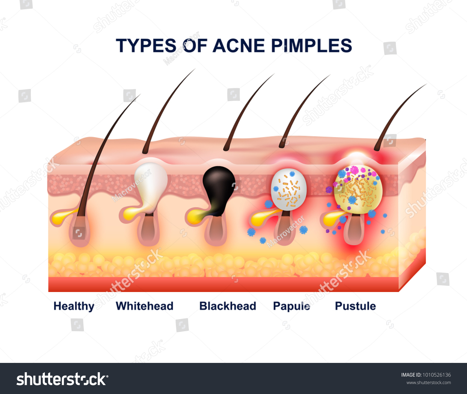 Anatomie Der Farbigen Akne Mit Akne Typen Stockillustration