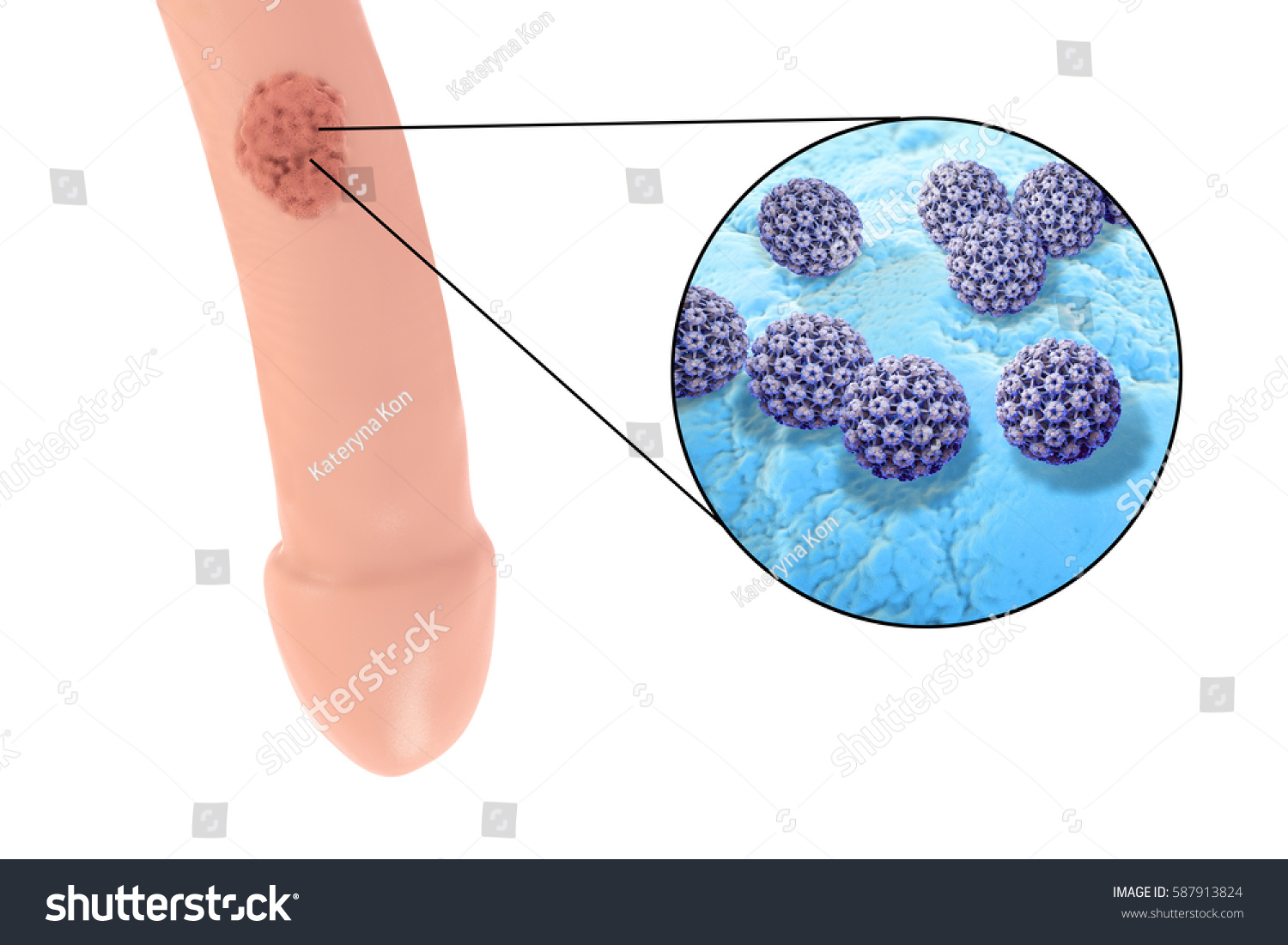 HPV HPV 3D 587913824   Stock Photo Common Locations Of Genital Warts Human Papillomavirus Hpv Lesions In Men And Close Up View Of 587913824 