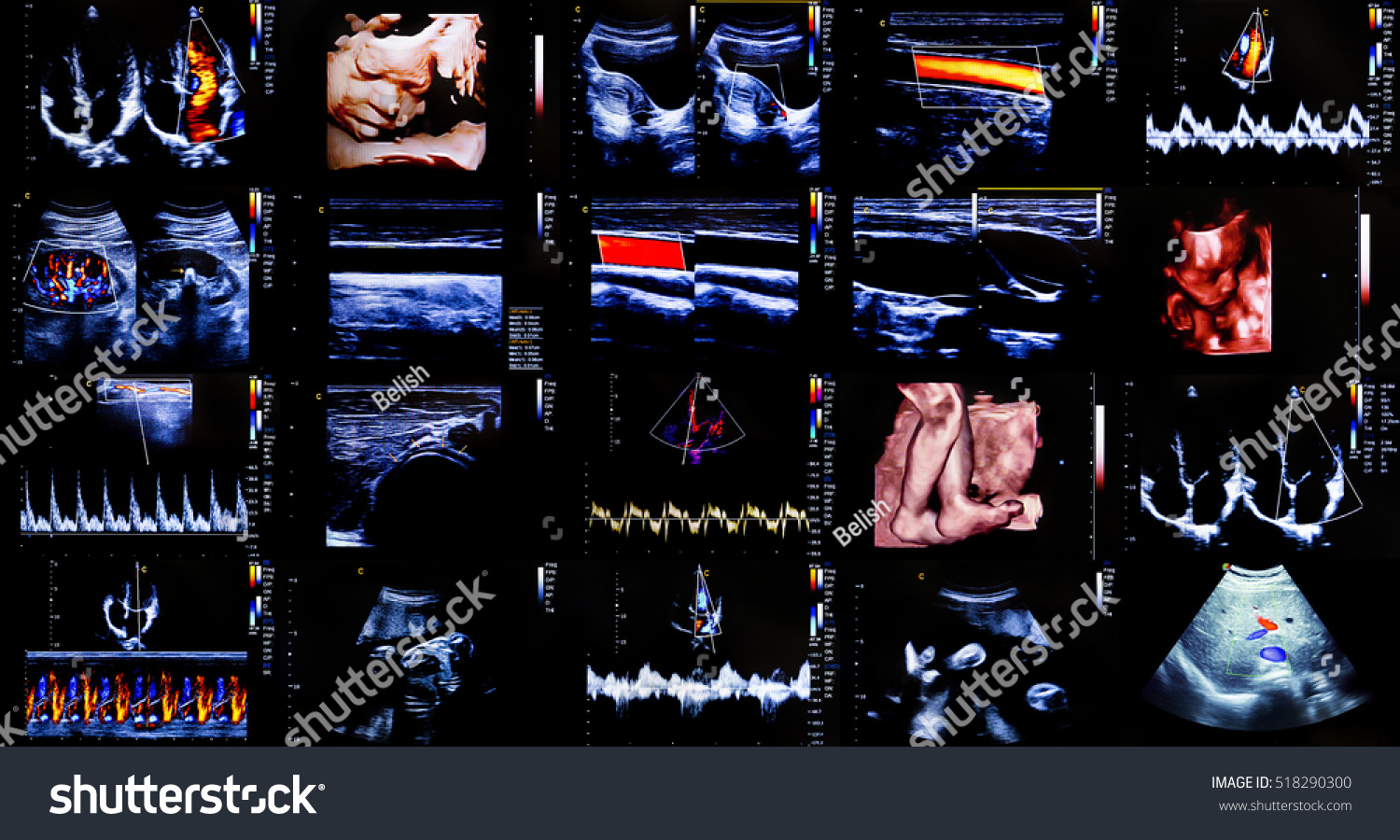 Compilation Og 20 Modern Echocardiography Ultrasound Stock Photo