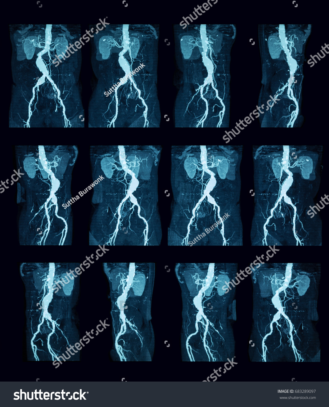 Computed Tomography Angiography Ct Angiography Cta Stock Photo ...