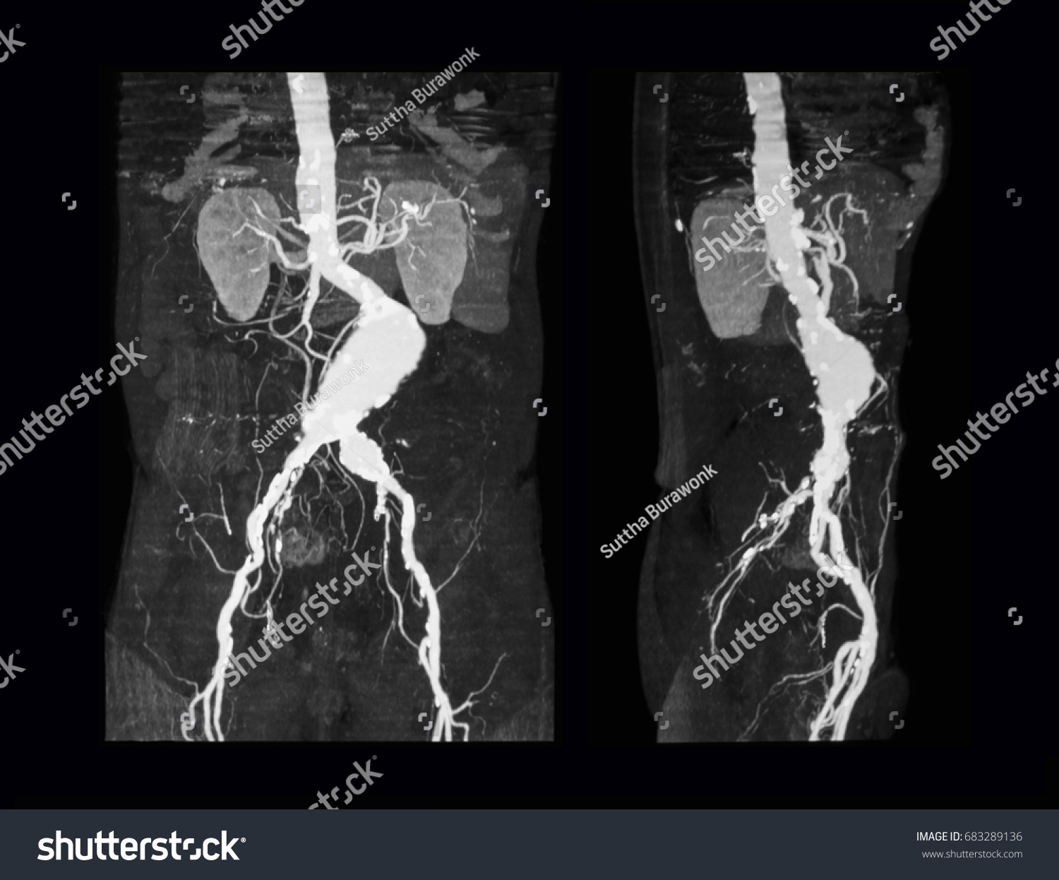 Computed Tomography Angiography Ct Angiography Cta Stock Photo Shutterstock