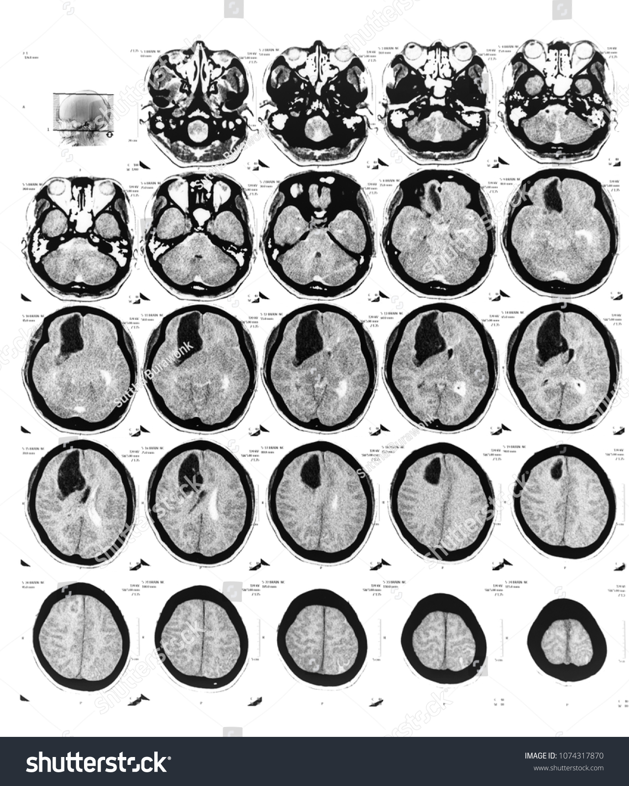 Computed Tomography Ct Brain Transverse Axial Stock Photo 1074317870 ...