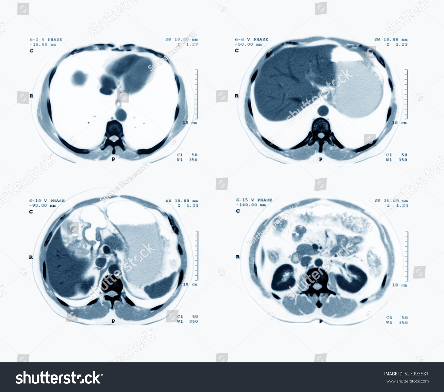 Computed Tomography Ct Scan Abdomen Contrast Foto Stock 627993581 Shutterstock 6640