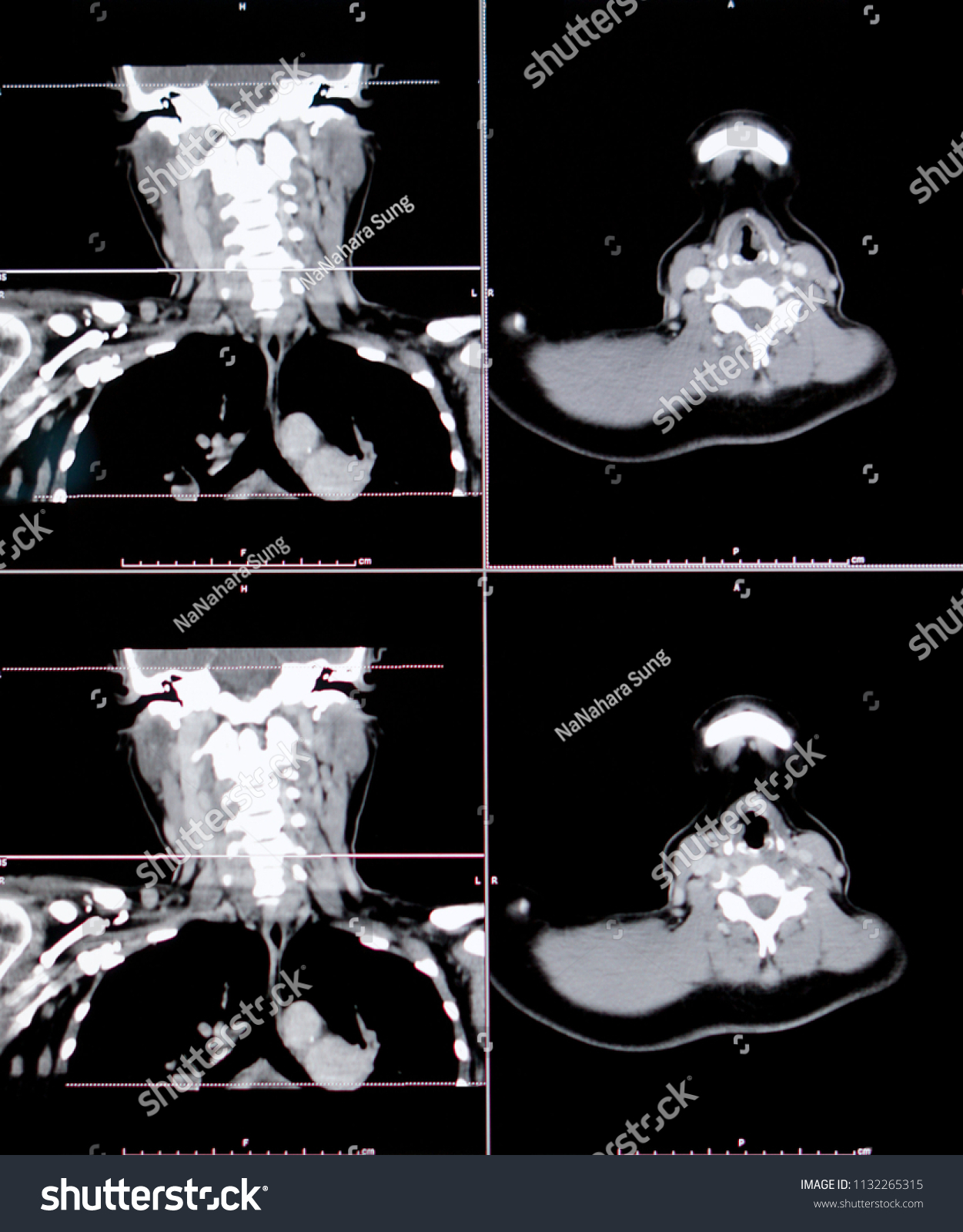 Computed Tomography Ct Scan Neck Ct Stock Photo (Edit Now) 1132265315
