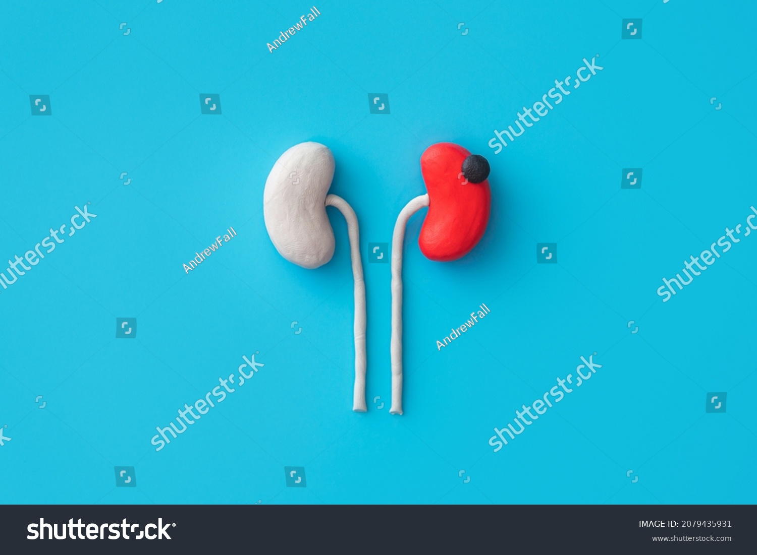 344 Renal cell carcinoma Images, Stock Photos & Vectors | Shutterstock