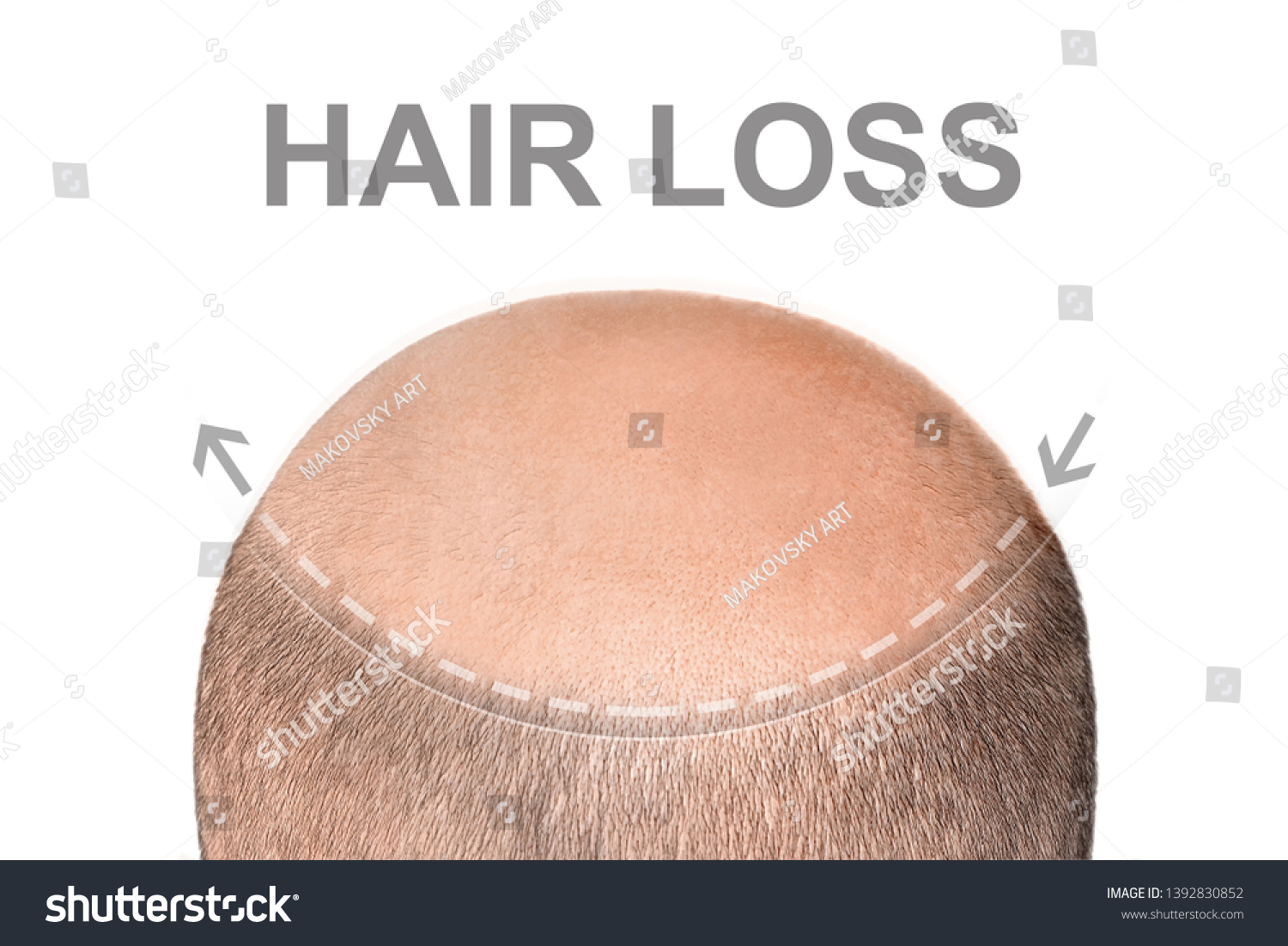 Concept Hair Loss Back View Balding Stock Photo Edit Now 1392830852