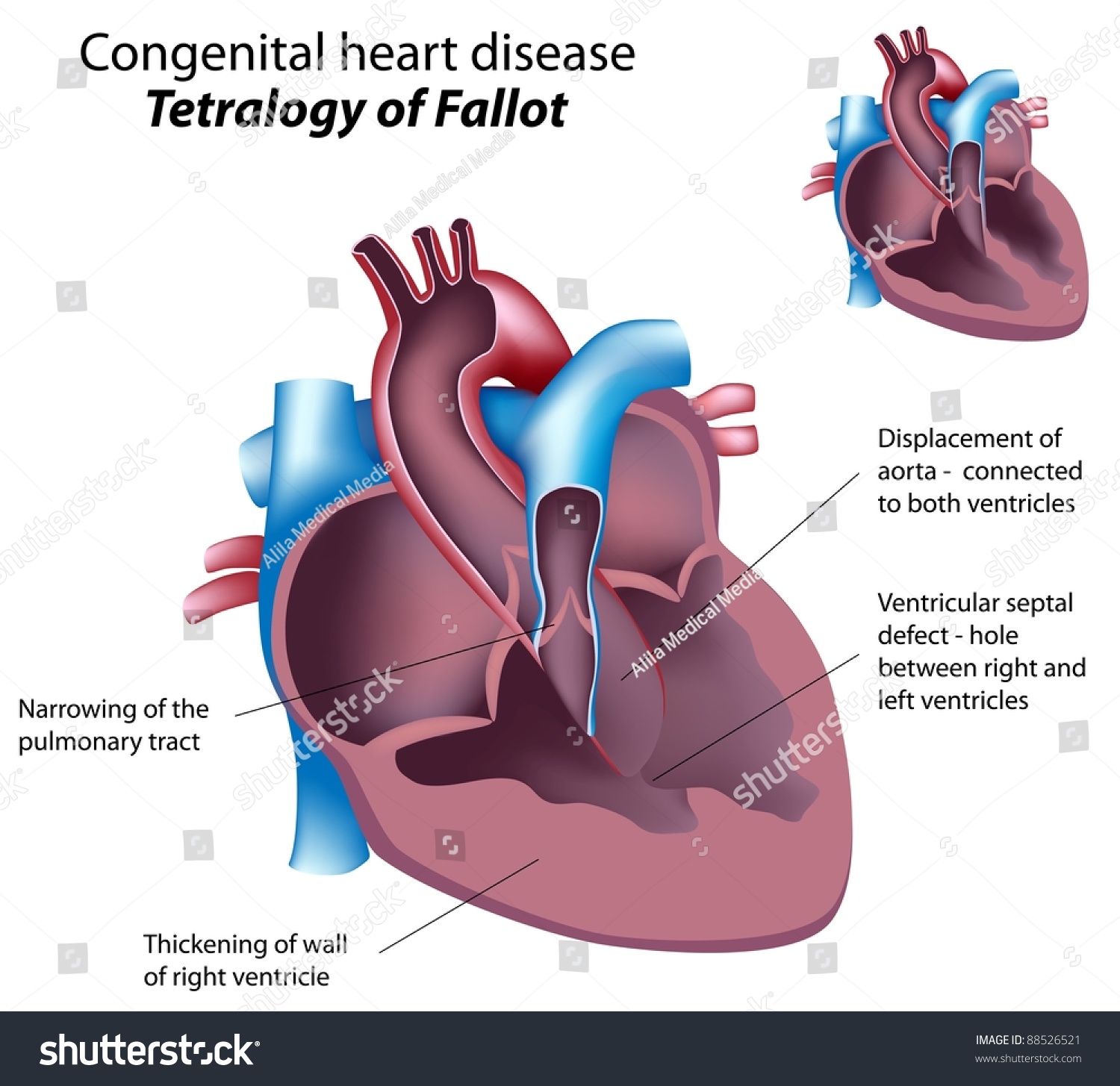 Congenital Heart Disease Tetralogy Fallot 库存插图88526521