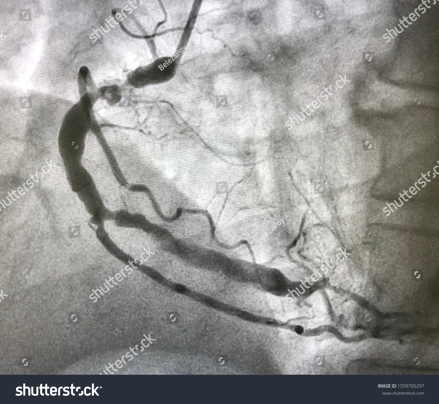 coronary-angiogram-shown-right-coronary-artery-nh-c-s-n-ch-nh-s-a