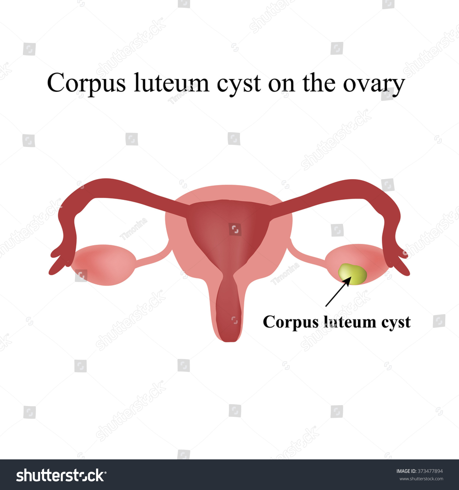 Corpus Luteum Cyst On Ovary Functional Stock Illustration 373477894 ...