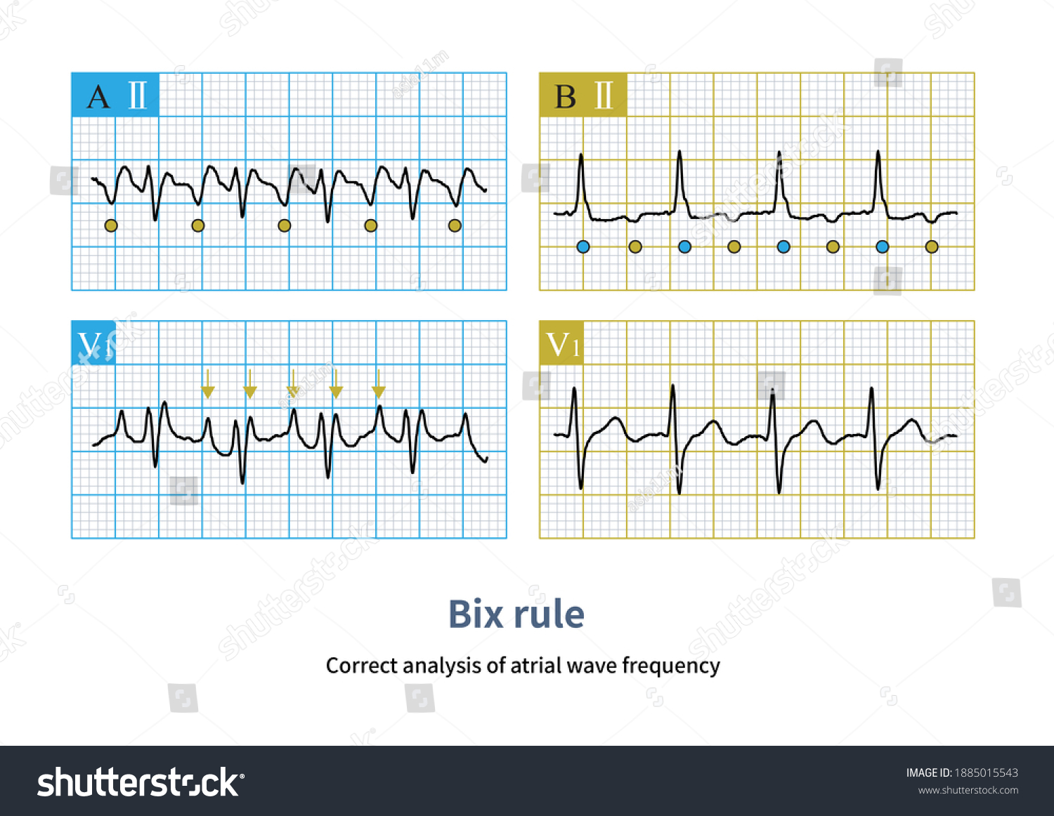 Correct Analysis Atrial Wave Frequency Tachycardia Stock Illustration ...