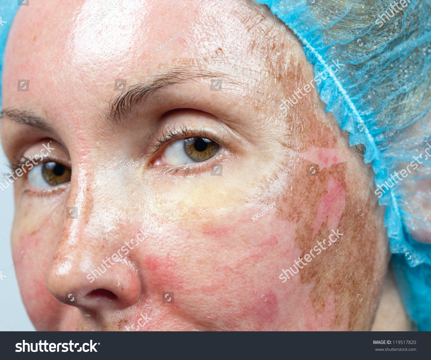 Cosmetology New Skin After Chemical Peeling Stock Photo 