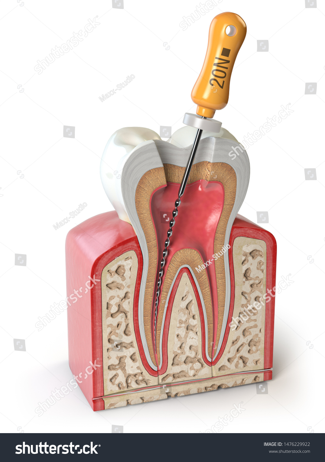 Cross Section Human Tooth Endodontic File Stock Illustration