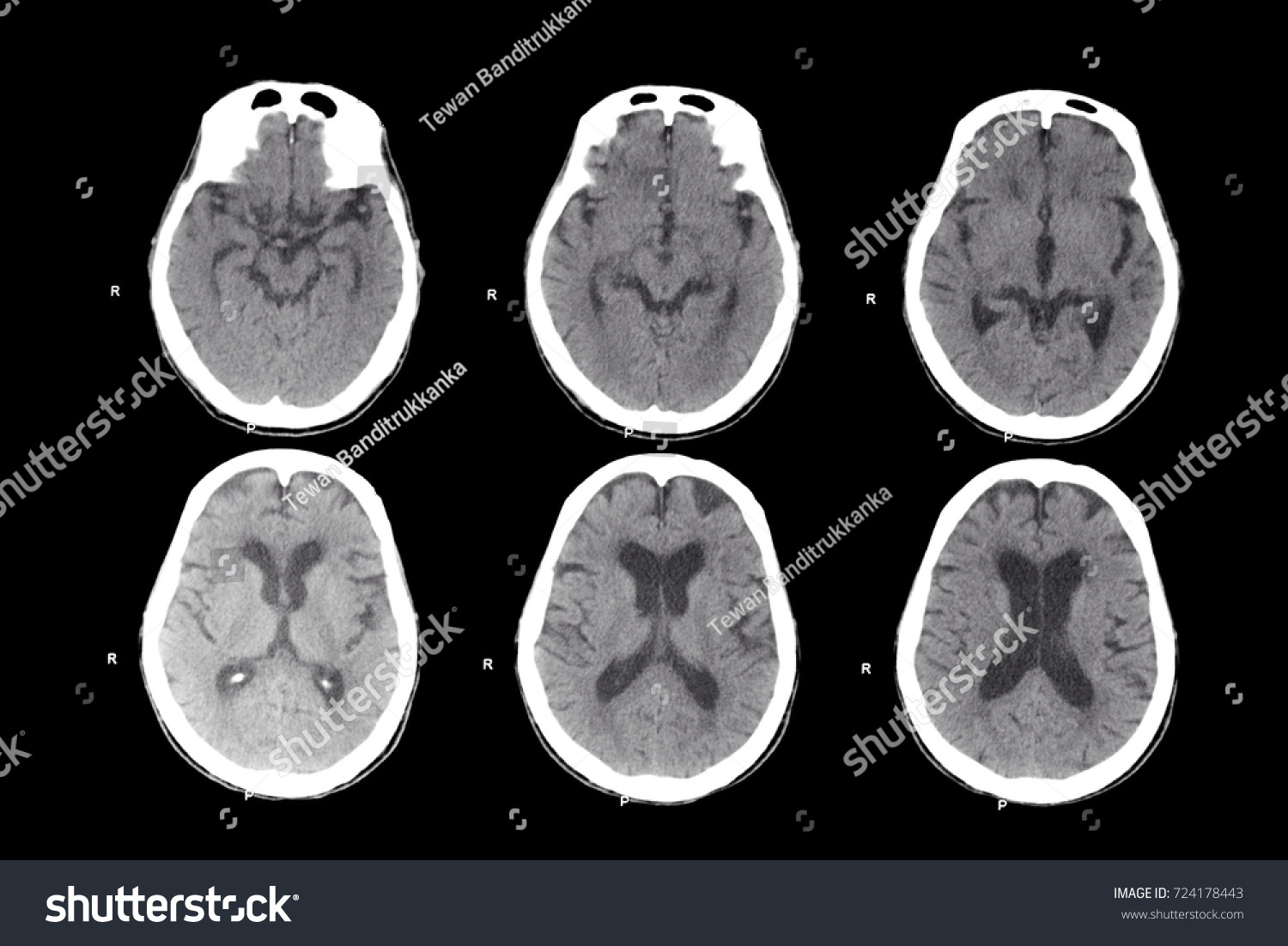 Ct Brain Stock Photo 724178443 | Shutterstock