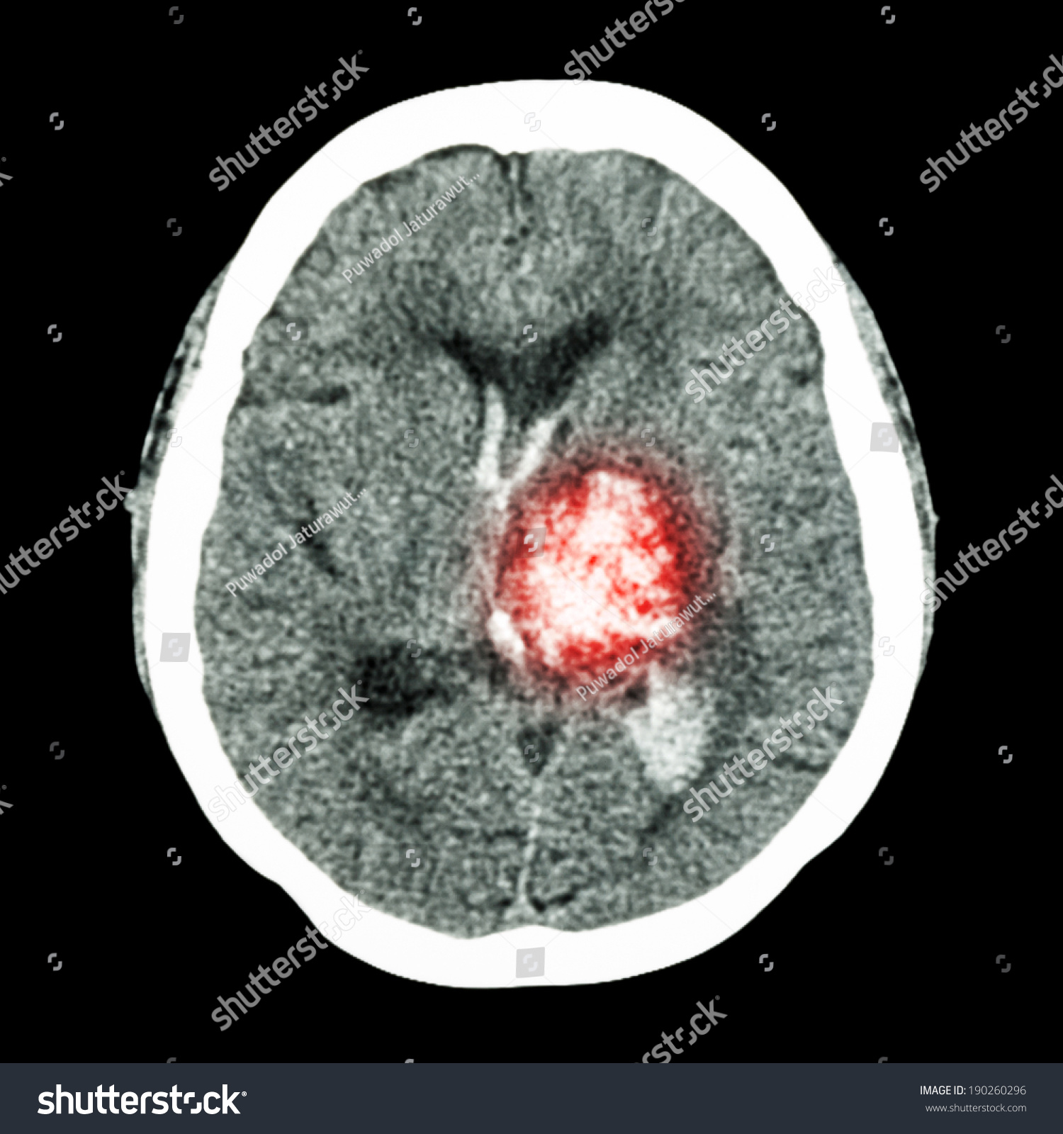 Ct Brain Show Left Thalamic Hemorrhage Stock Photo 190260296 - Shutterstock