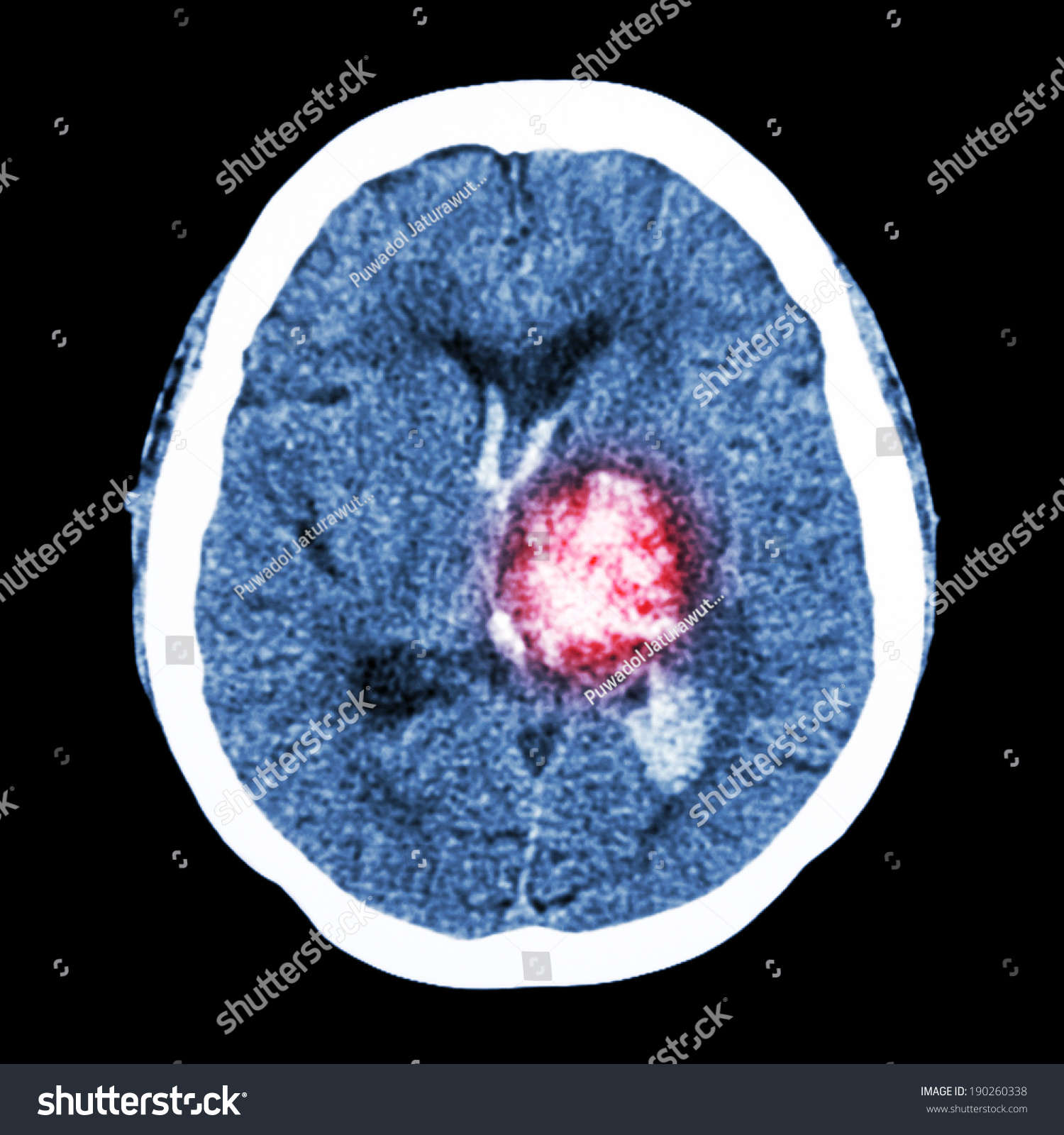 Ct Brain : Show Left Thalamic Hemorrhage (Hemorrhagic Stroke) Stock ...