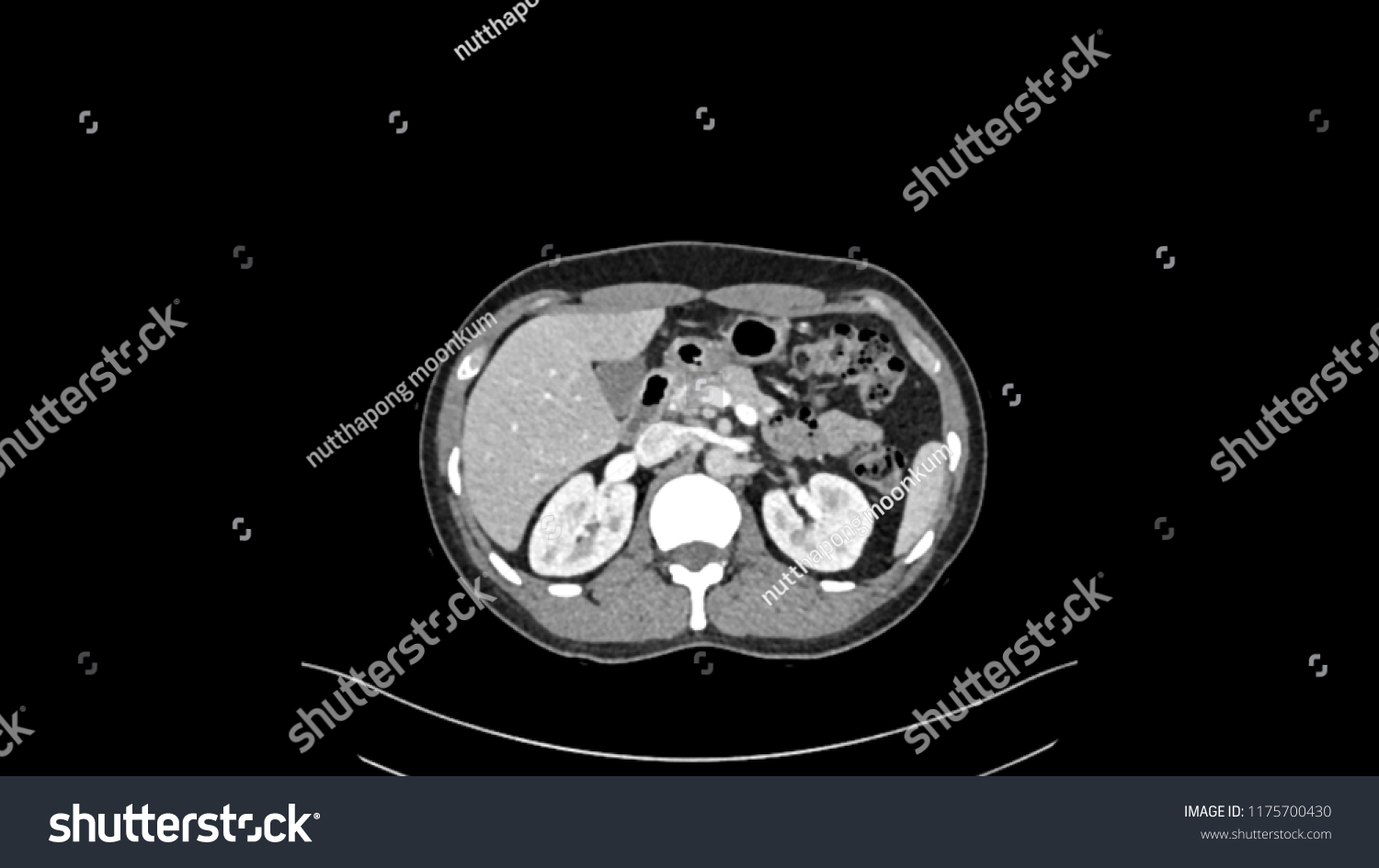 Ct Scan Liver Mass Stock Illustration 1175700430 | Shutterstock