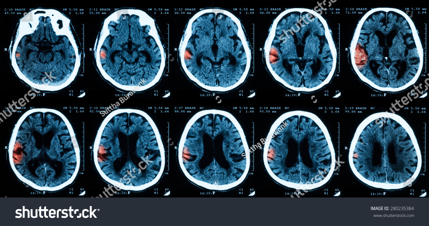 Ct Scan Brain Intracerebral Hemorrhages ภาพสตอก Shutterstock