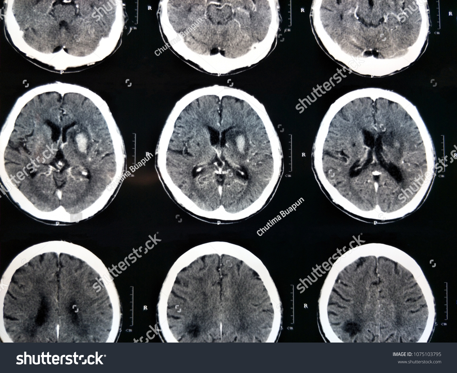 Ct Scan Brain Contrast Stock Photo 1075103795 | Shutterstock