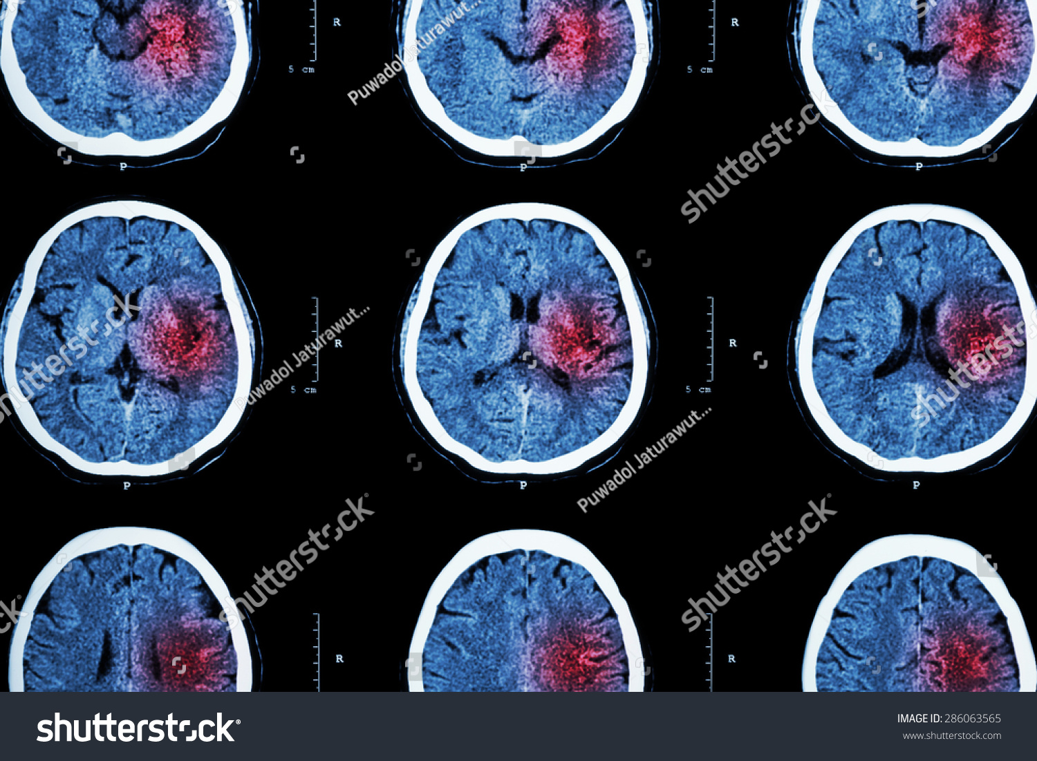 Ct Scan Brain Red Area Imaging Stock Photo 286063565 - Shutterstock