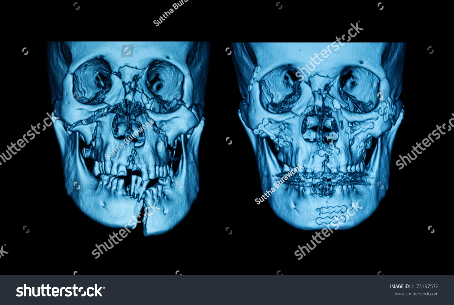 Ct Scan Facial Bone Fractures Front Foto Stock Shutterstock