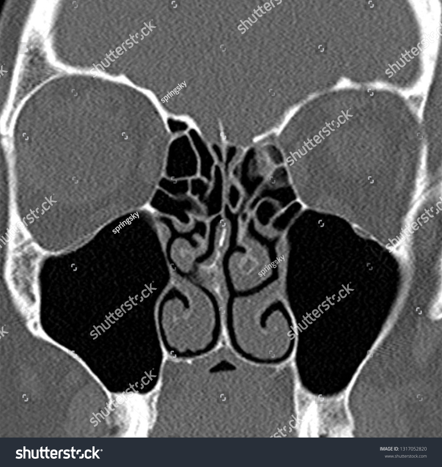 Ct Scan Human Paranasal Sinuses Many Stock Photo Edit Now