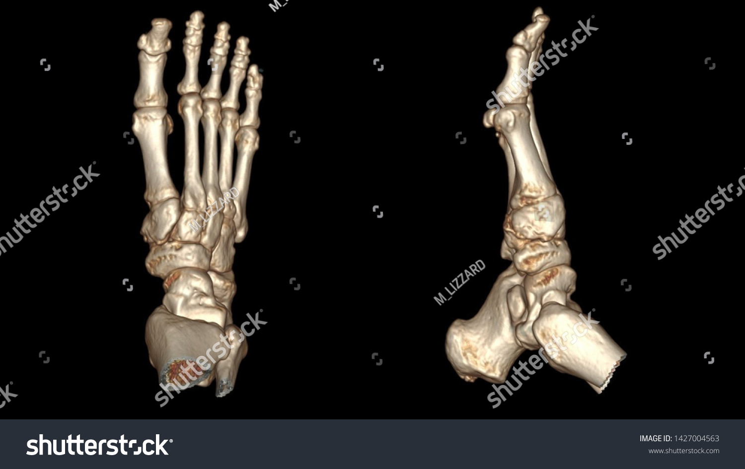 Ct Scan Right Foot 3d Rendering Stock Illustration 1427004563 ...