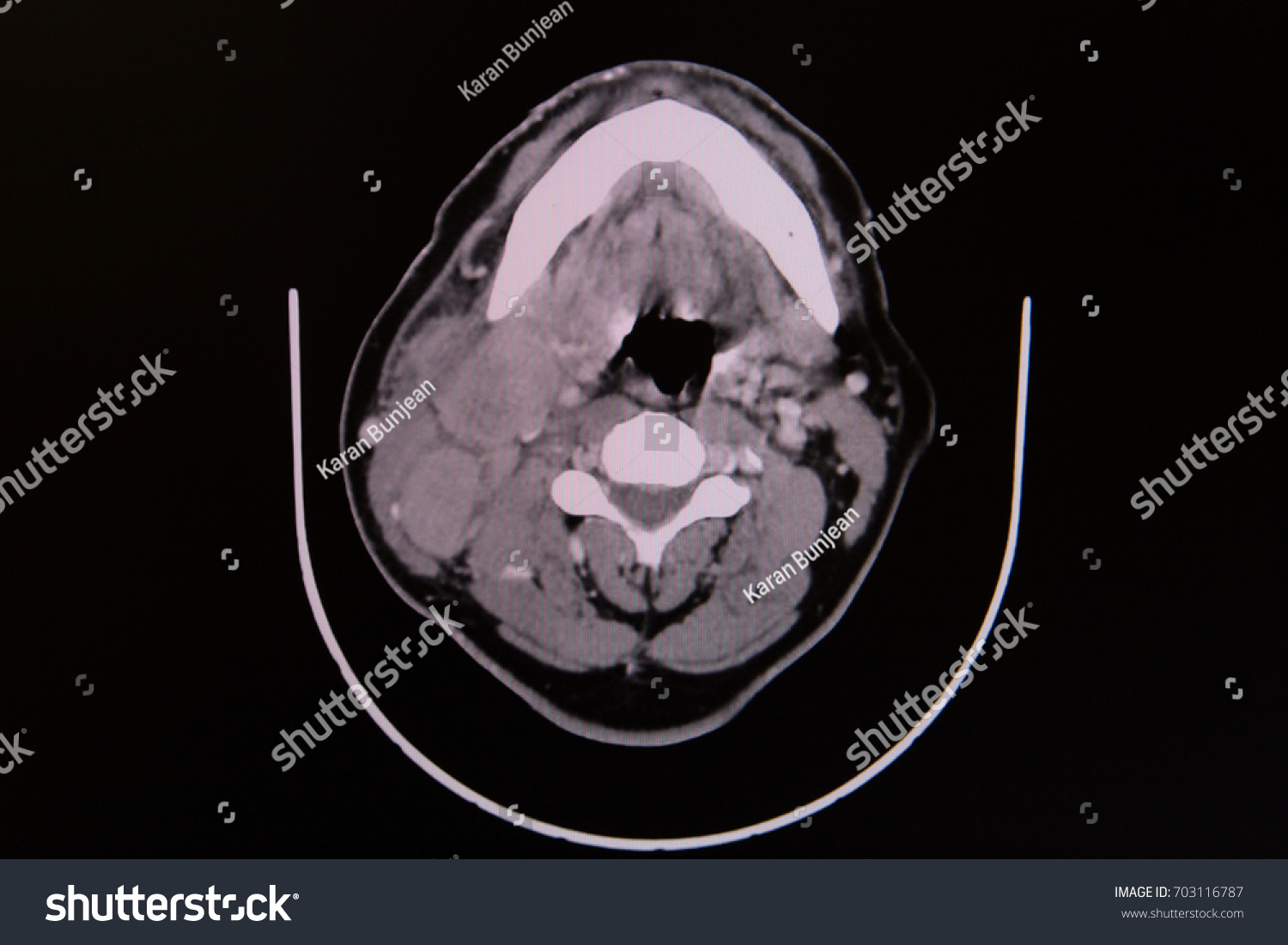 Ct Scan Enlarged Lymph Nodes