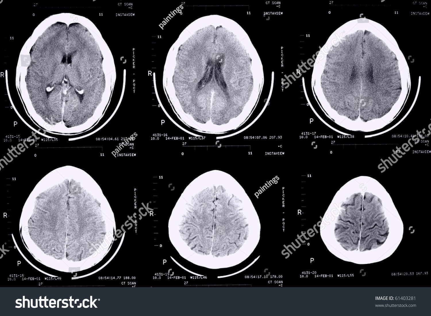 Ct Scan Of 30 Year Old Male Skull And Brain Stock Photo 61403281 ...