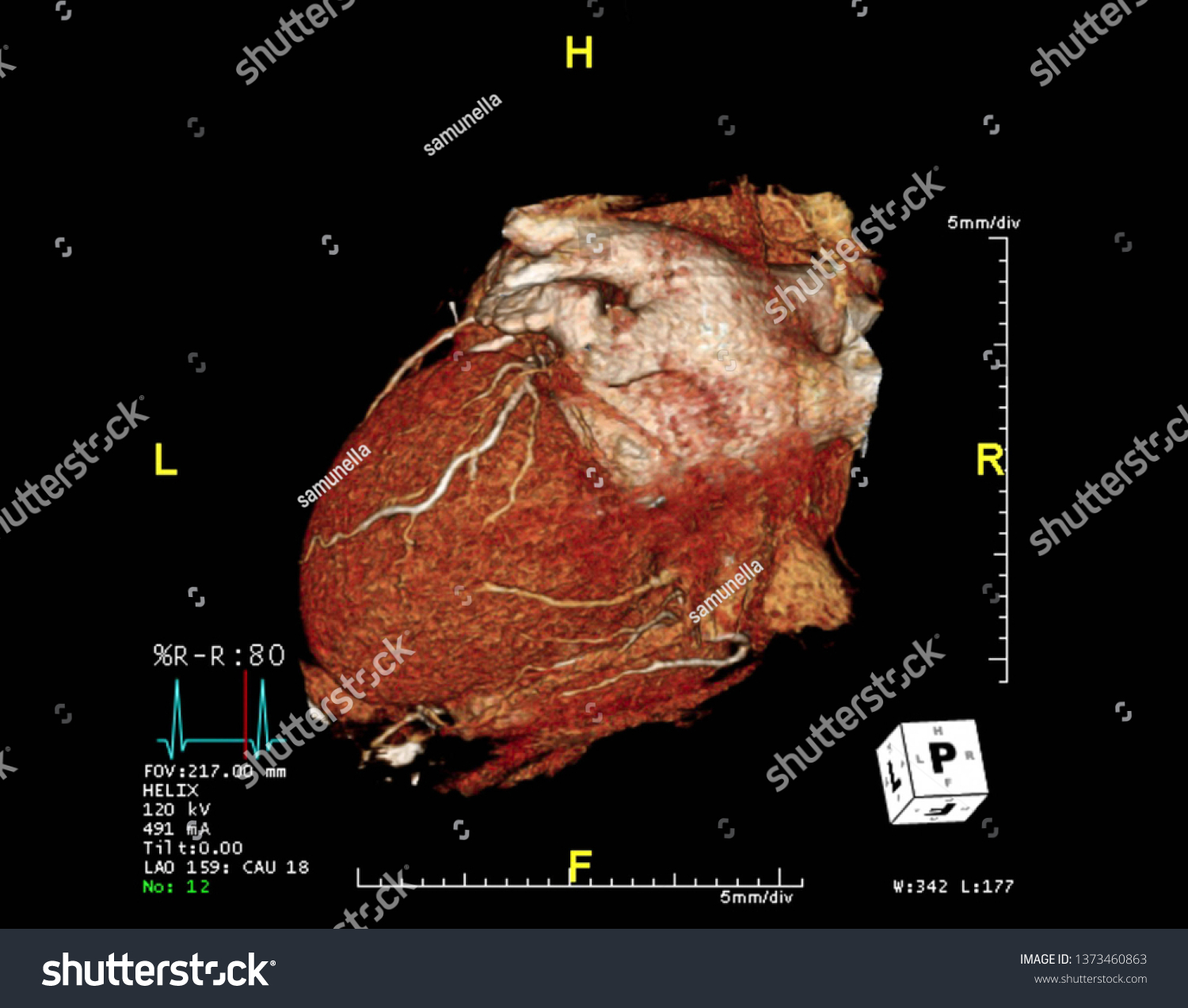 Cta冠動脈3dレンダリングイメージlaoビューを画面から表示 心臓血管疾患のct血管造影 法 のイラスト素材