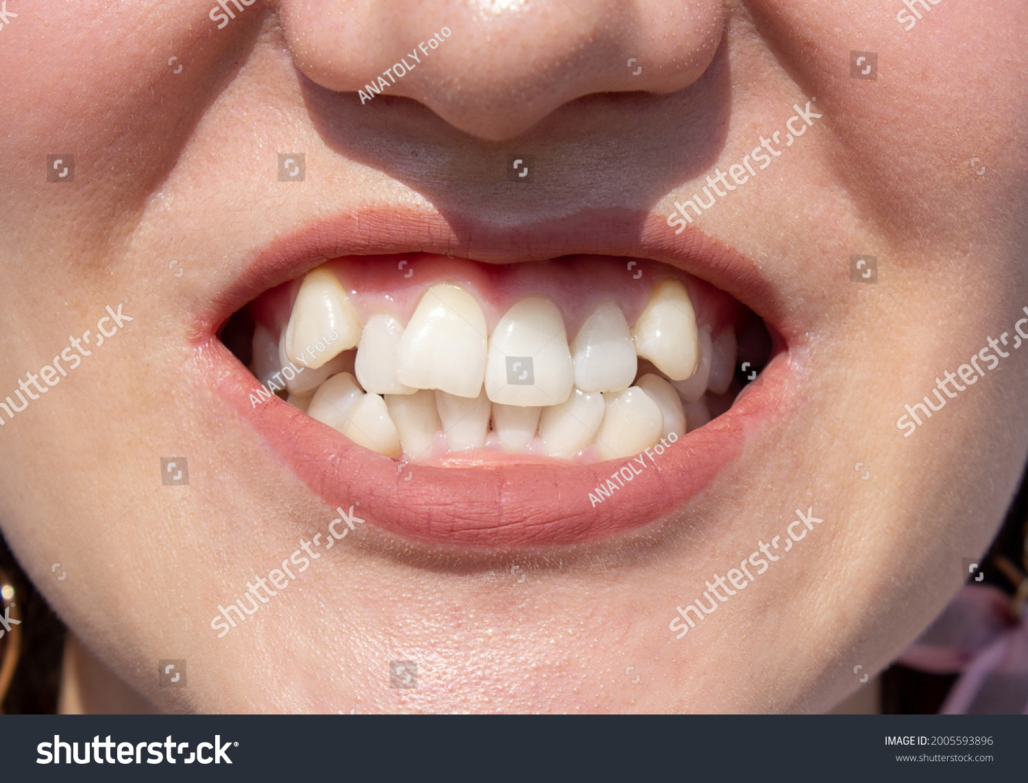 lack-tooth-images-stock-photos-vectors-shutterstock