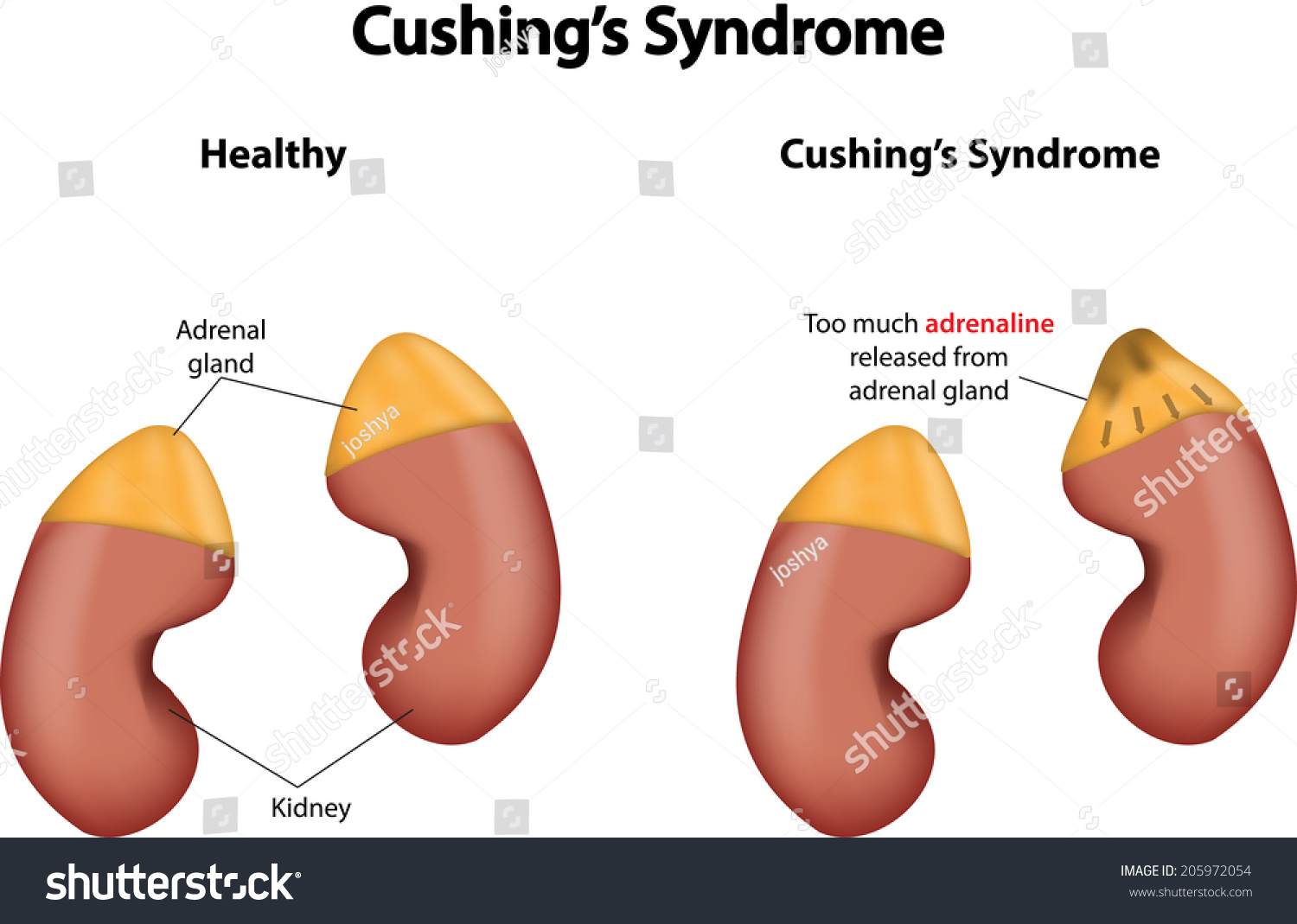 Cushings Syndrome Stock Illustration 205972054 Shutterstock 