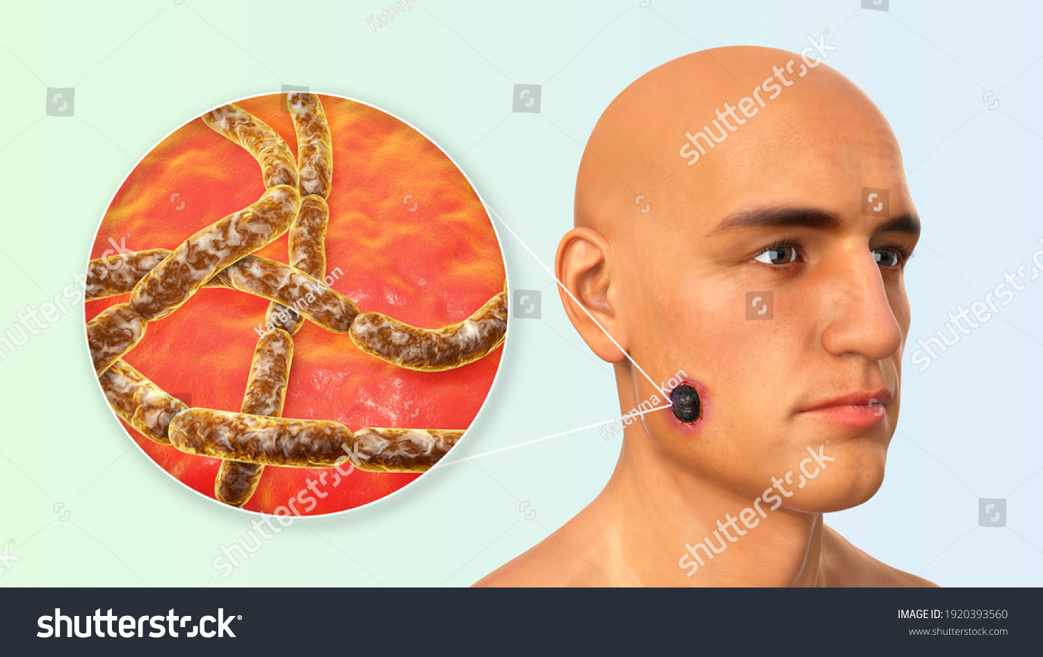 Cutaneous Anthrax Most Common Form Anthrax Stock Illustration 1920393560 Shutterstock 4793