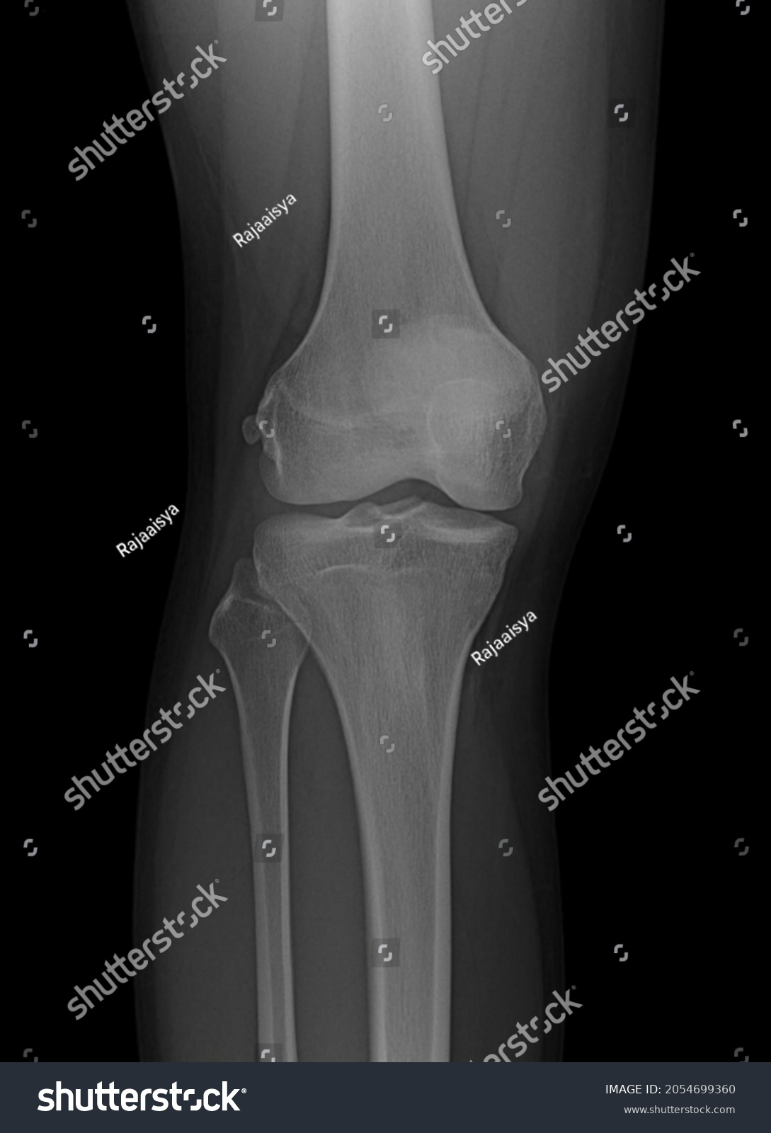 Cyamella Sesamoid Bone Knee X Ray Stock Photo (Edit Now) 2054699360