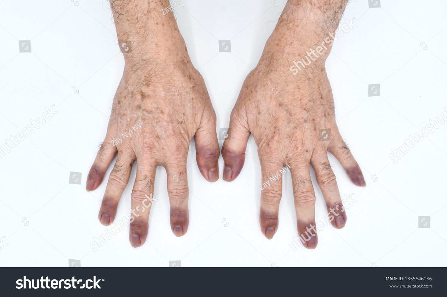 Cyanotic Hands Peripheral Cyanosis Blue Hands Stock Photo 1855646086