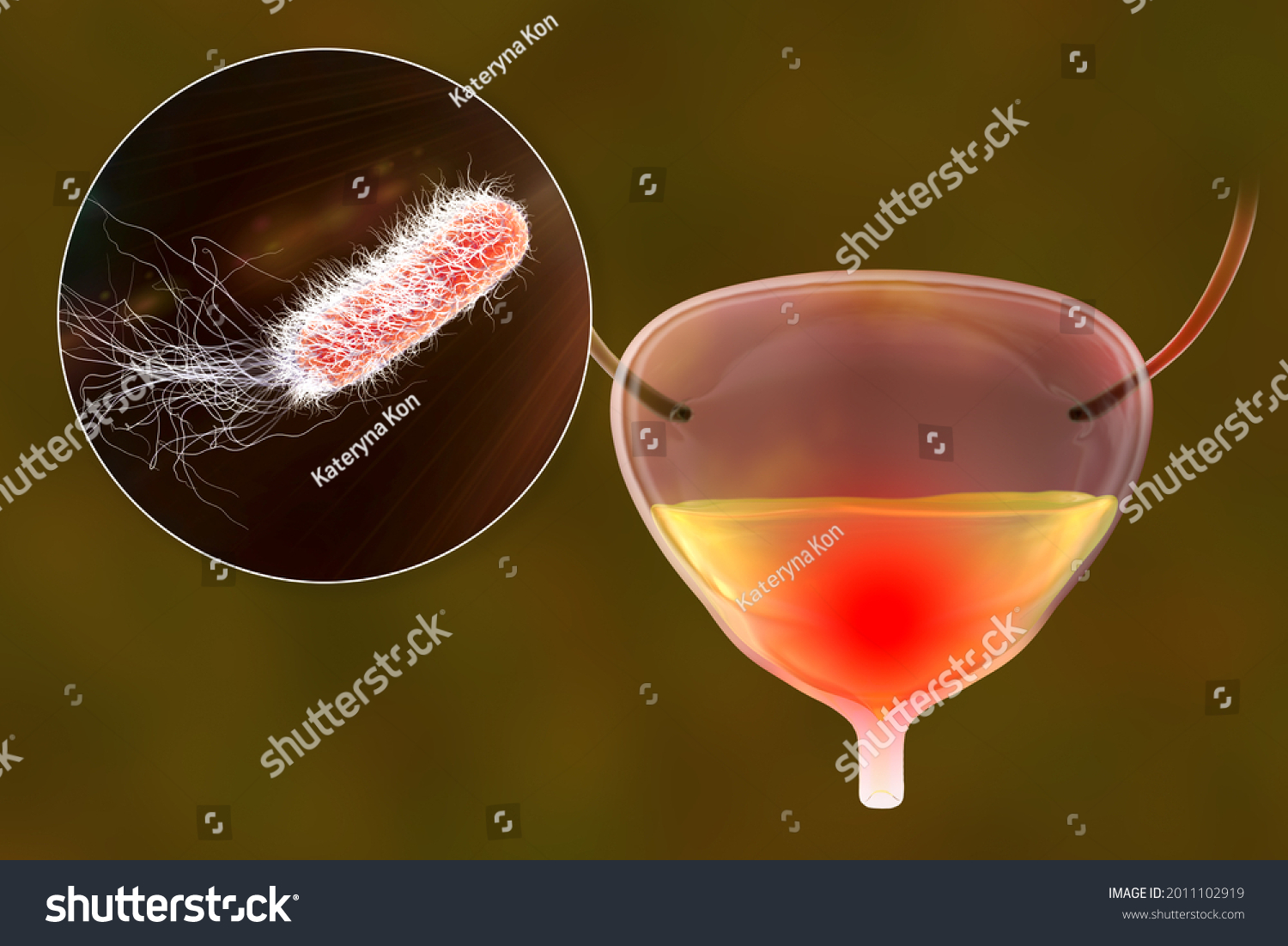 Cystitis Bacterial Infection Urinary Bladder Conceptual Stock ...