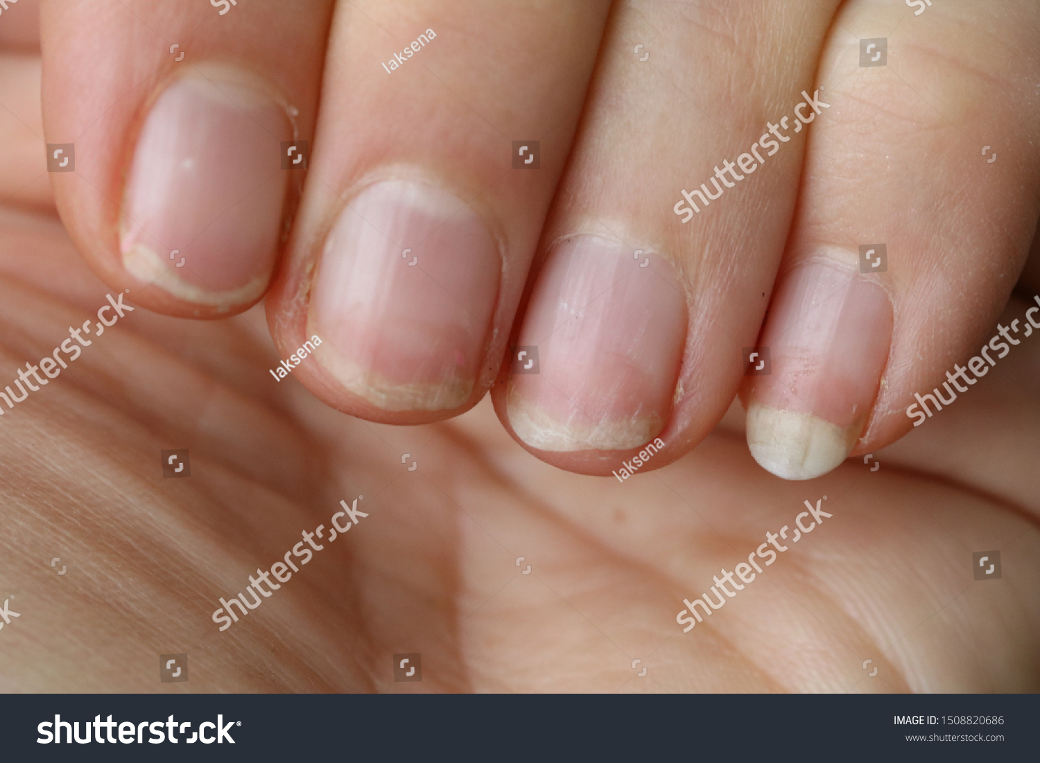 damaged nails