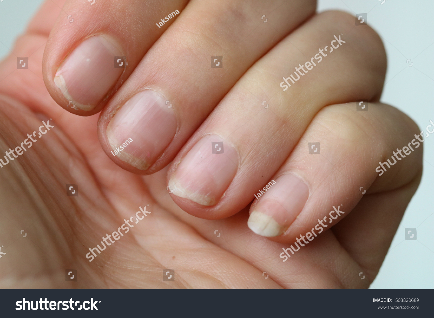 damaged nails