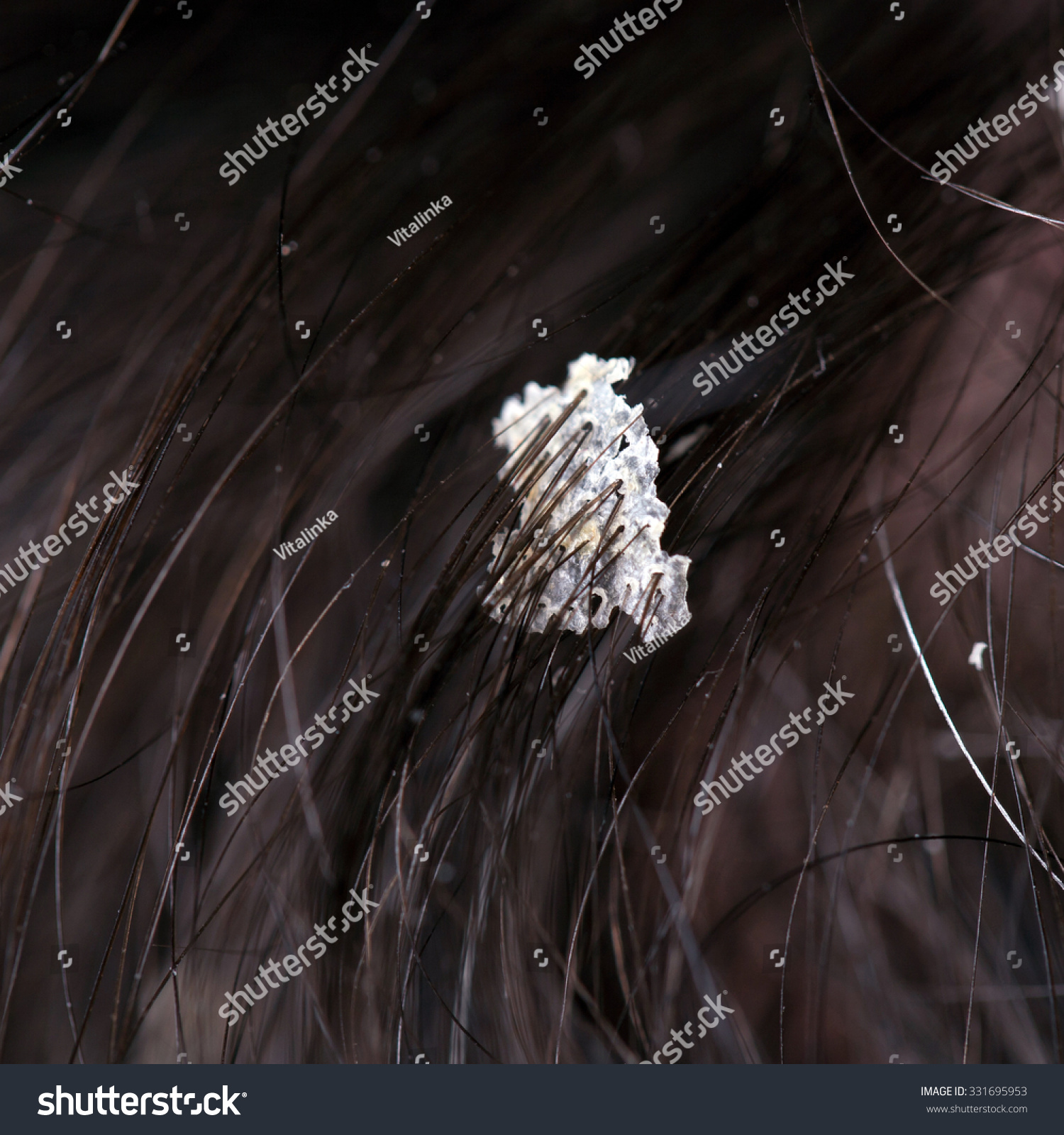 Dandruff Hair Flaky Scalp Seborrhea Macro Stock Photo 331695953