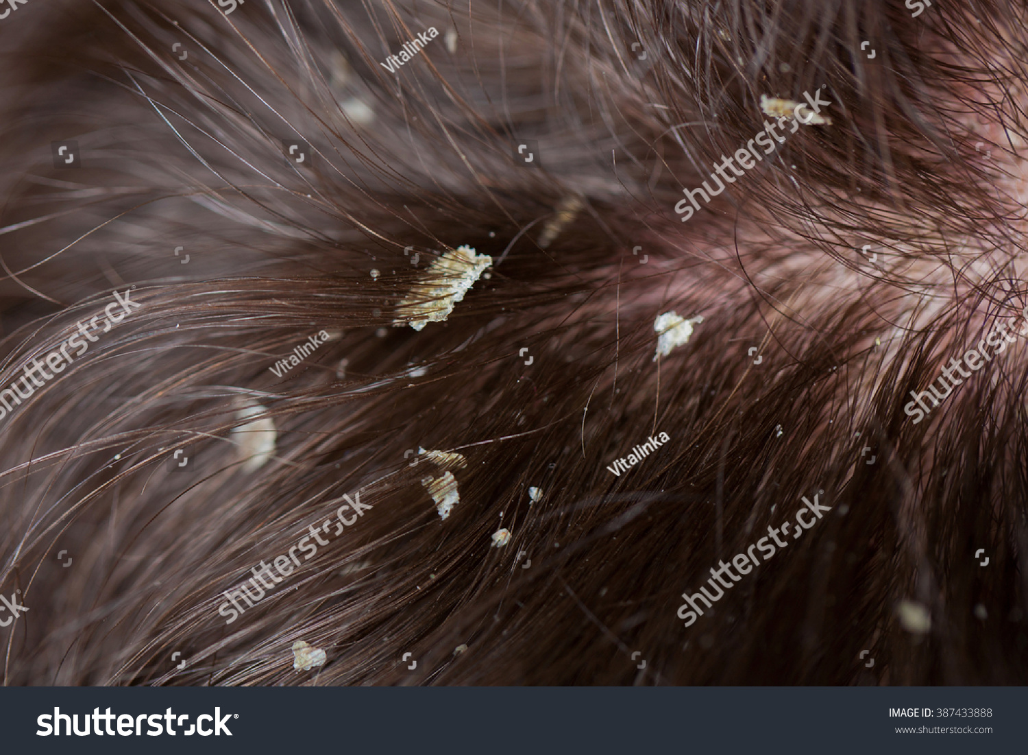 Dandruff In The Hair. Flaky Scalp. Seborrhea. Macro Shot Stock Photo ...