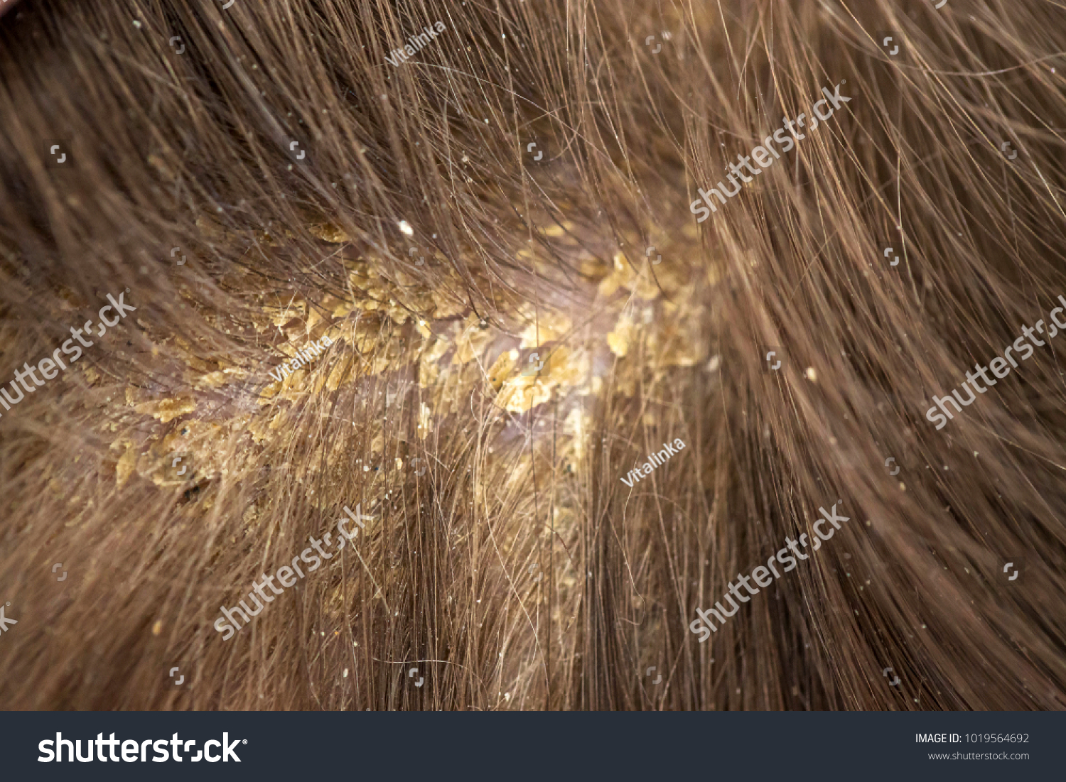 Dandruff Hair Flaky Scalp Seborrhea Macro Stock Photo 1019564692