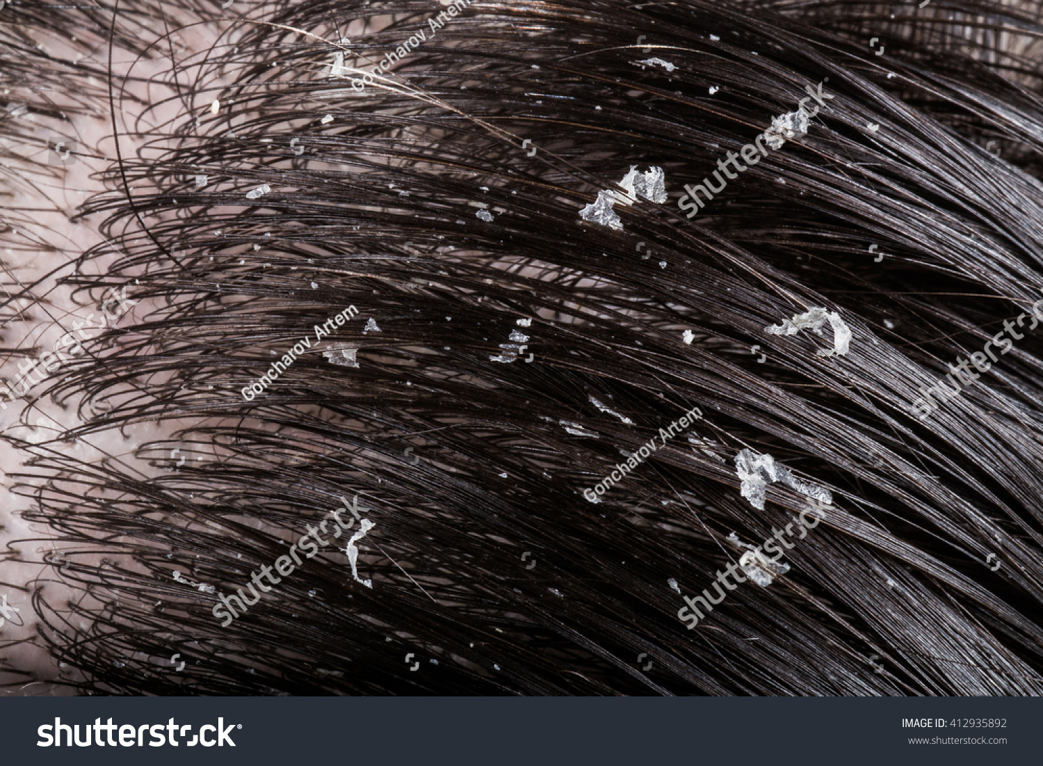 Dandruff On Her Dark Hair Stock Photo 412935892 Shutterstock