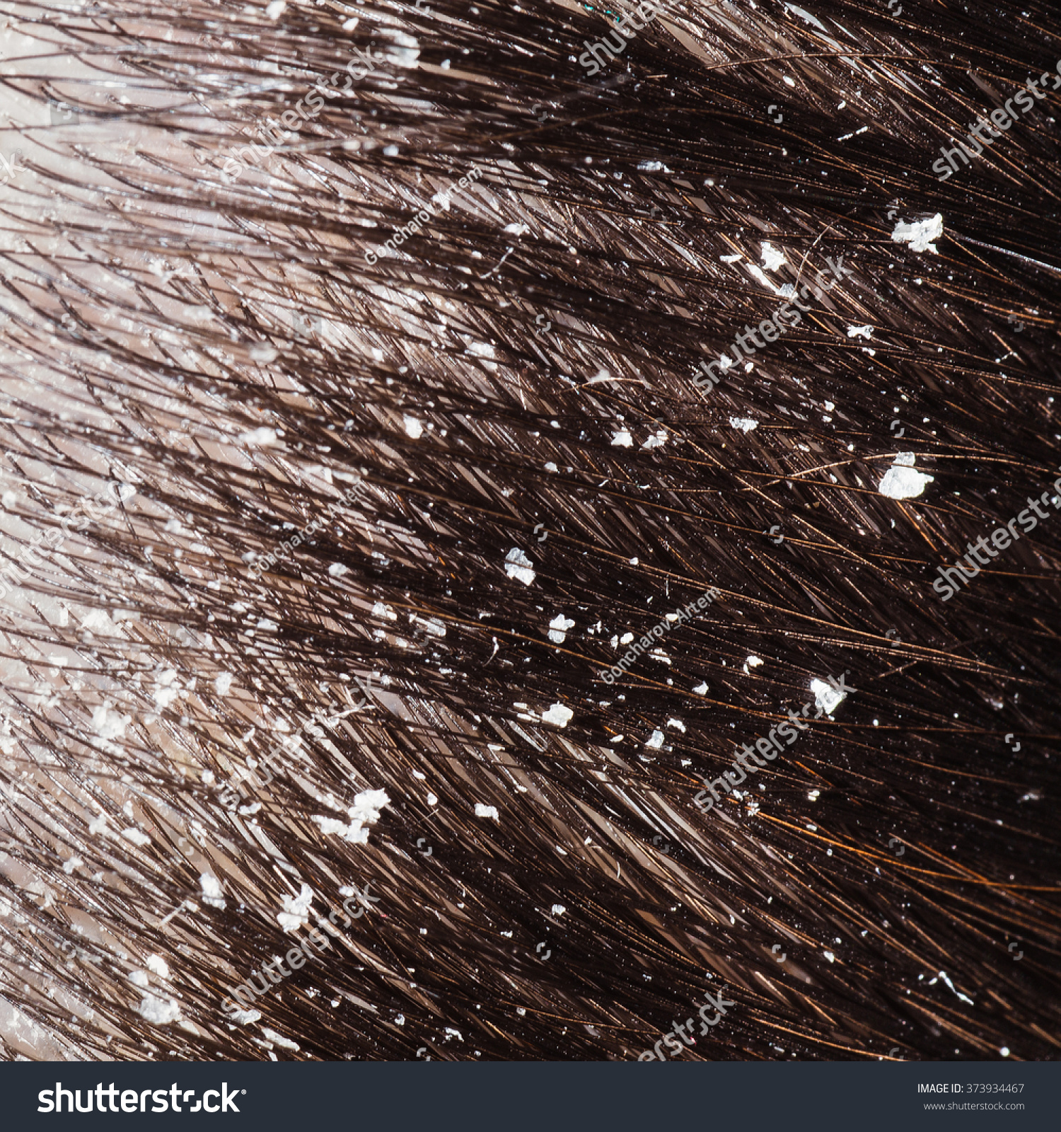 Dandruff On Her Dark Hair Macro Stock Photo 373934467 Shutterstock