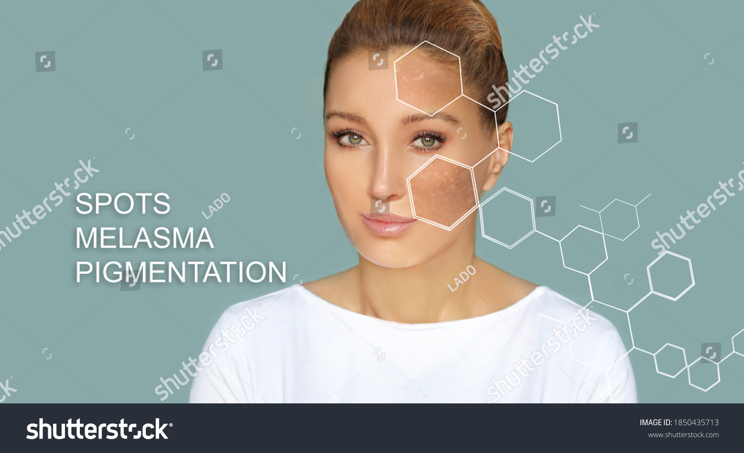 Dark Spots Freckleshyperpigmentationmelasma Chloasma Stock Photo (Edit ...