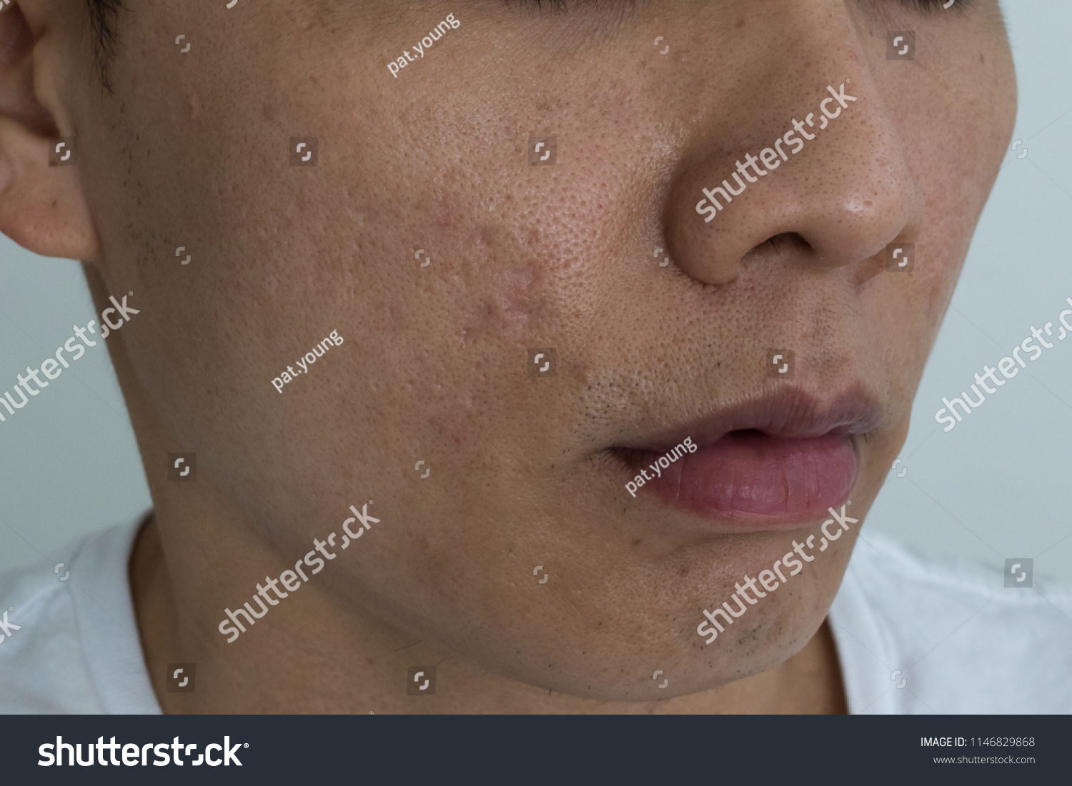 Manuel recommend best of supplement acne Manuel recommend best of supplement acne