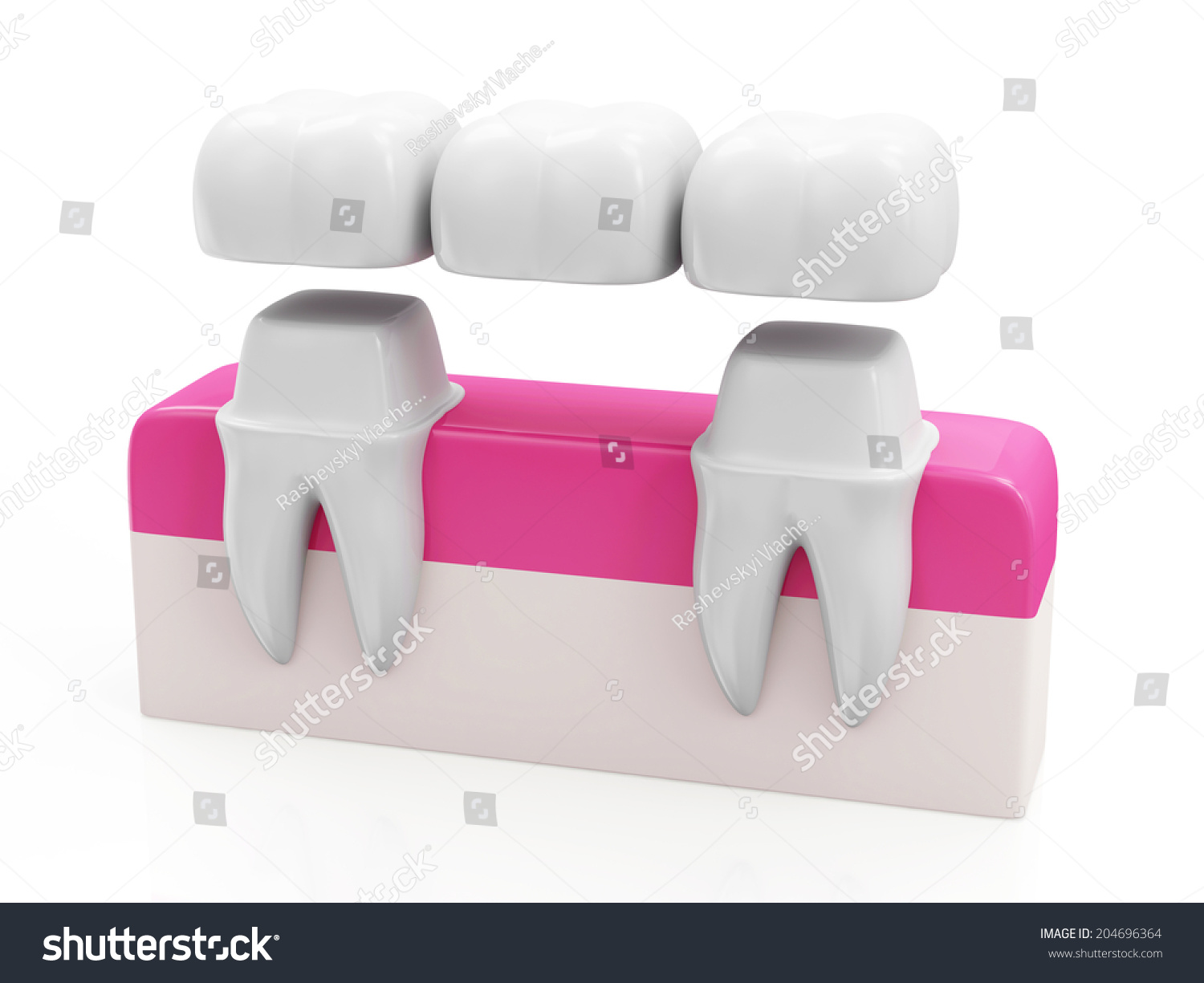 Dental Bridge Concept Dental Crown On Stock Illustration 204696364