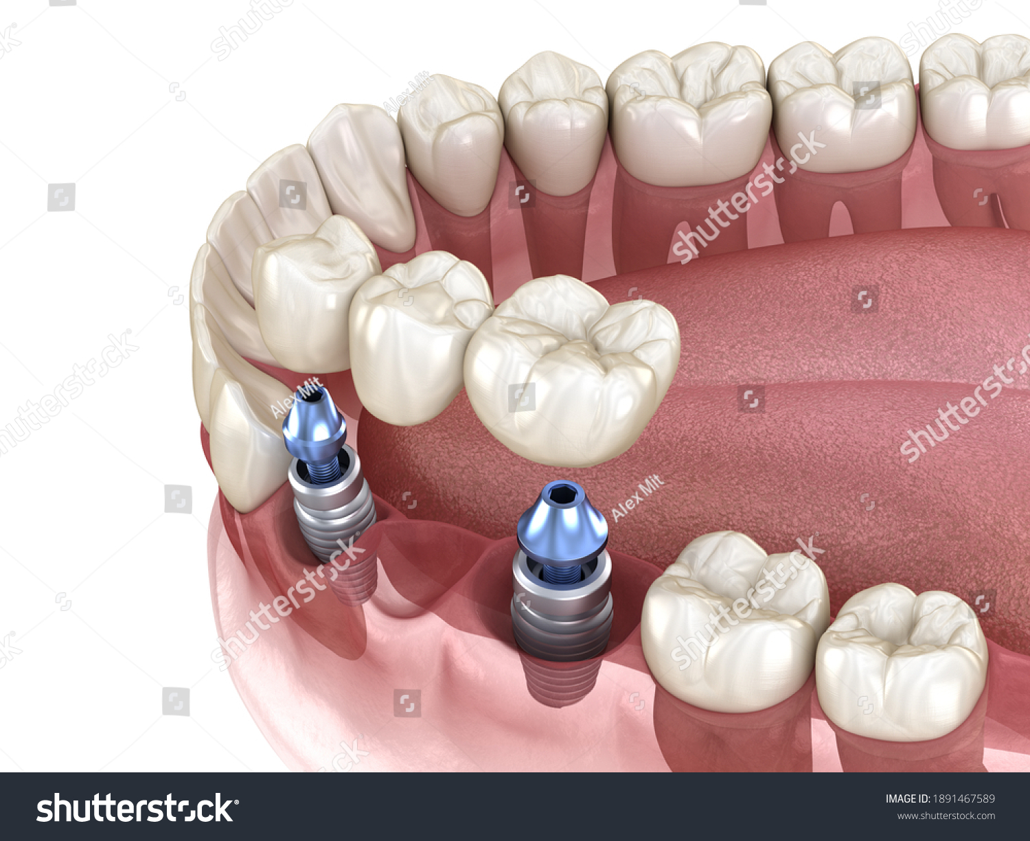 Dental Bridge Supported By Implants Medically Stock Illustration