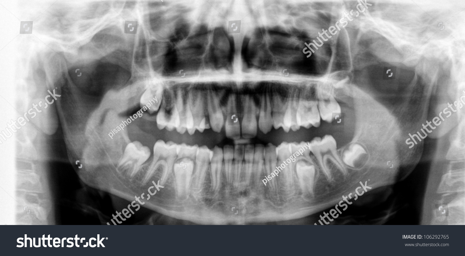 Dental Mri Xray Closeup Human Skull Stock Photo 106292765 - Shutterstock