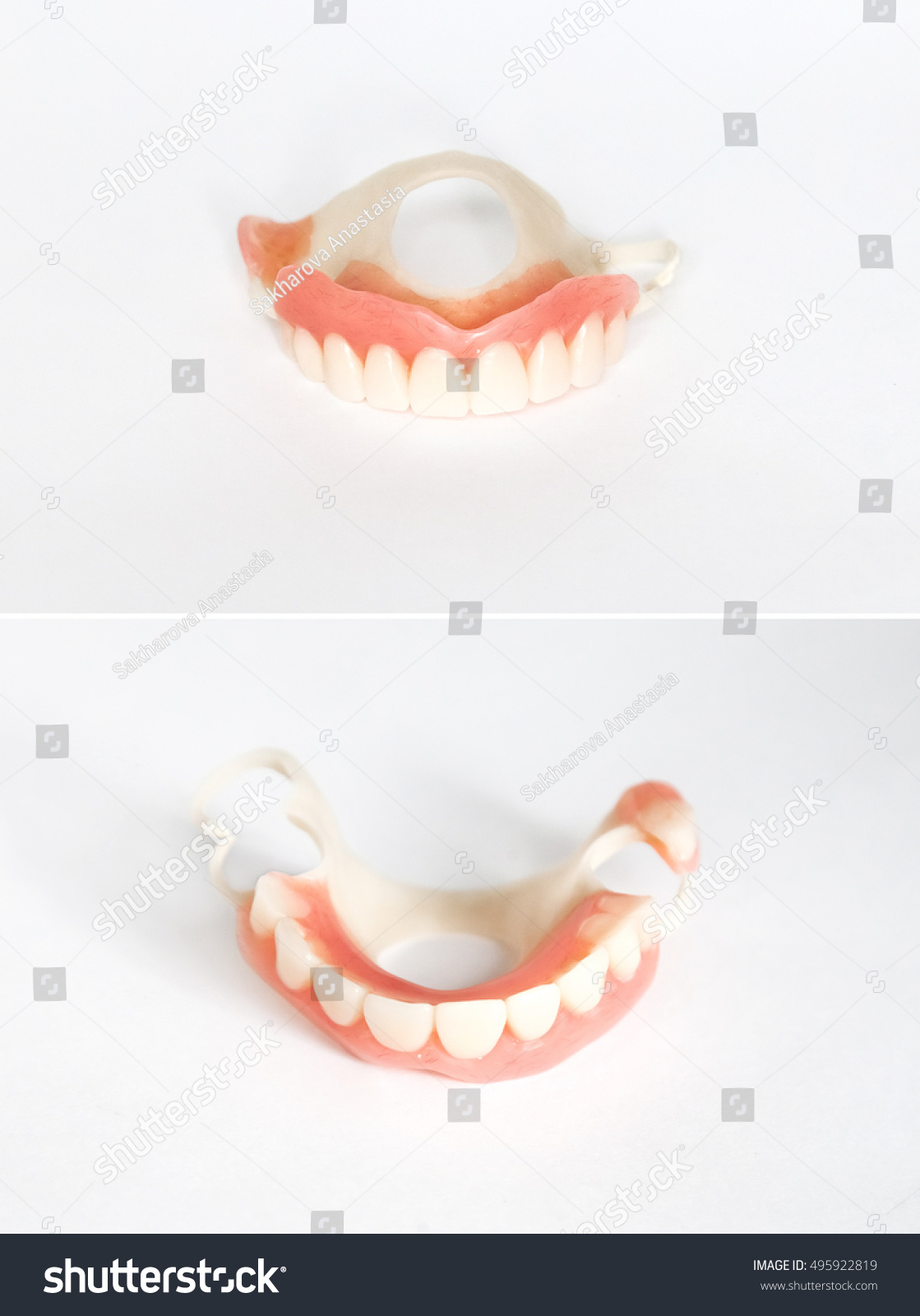 Clasp prosthesis for upper jaw Clasp prosthesis for upper jaw